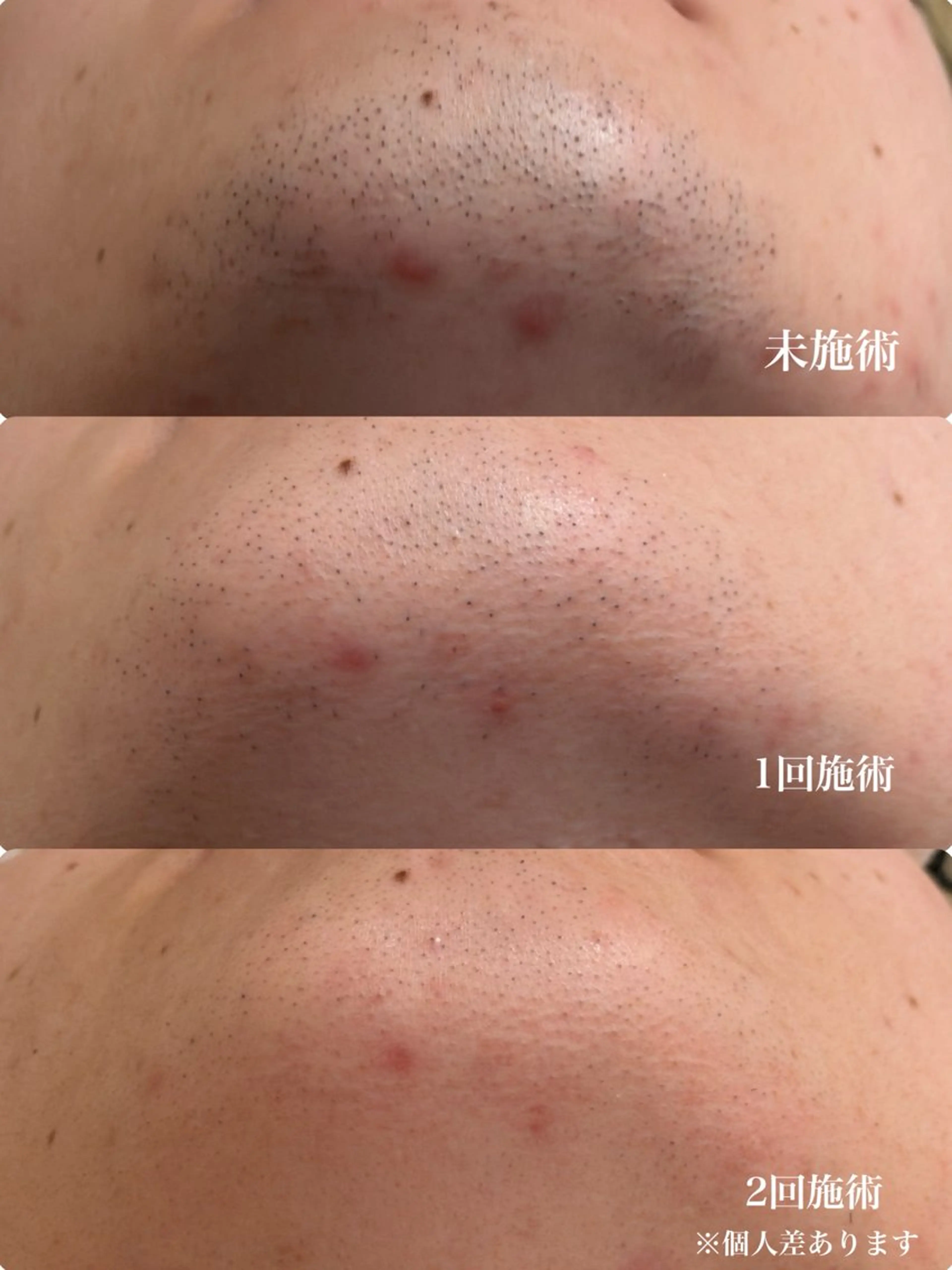 メンズ 脱毛 muumo まりののエステ・リラクイメージ