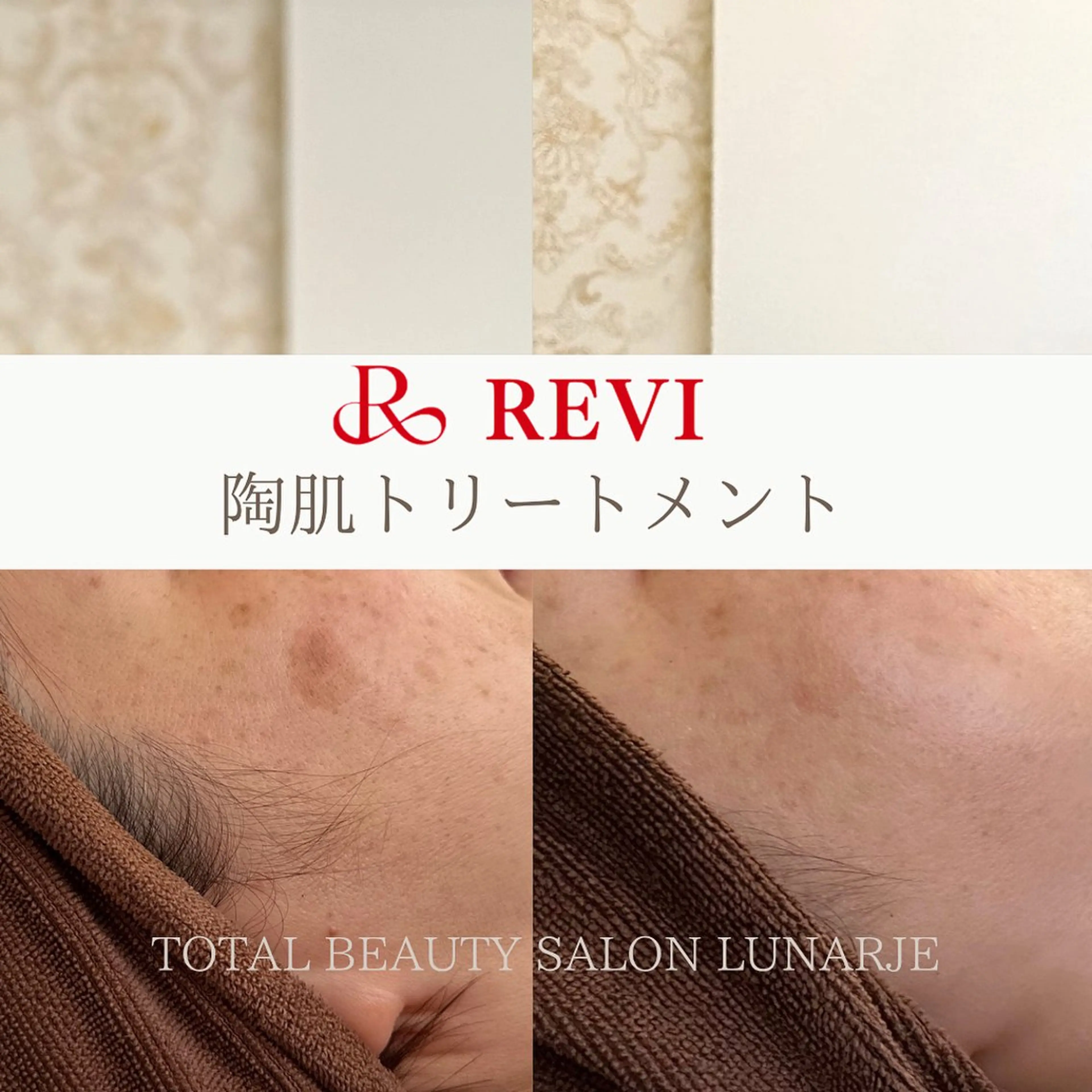 【平日限定☆】剥けないハーブピーリング 追加オプション2個無料!の写真