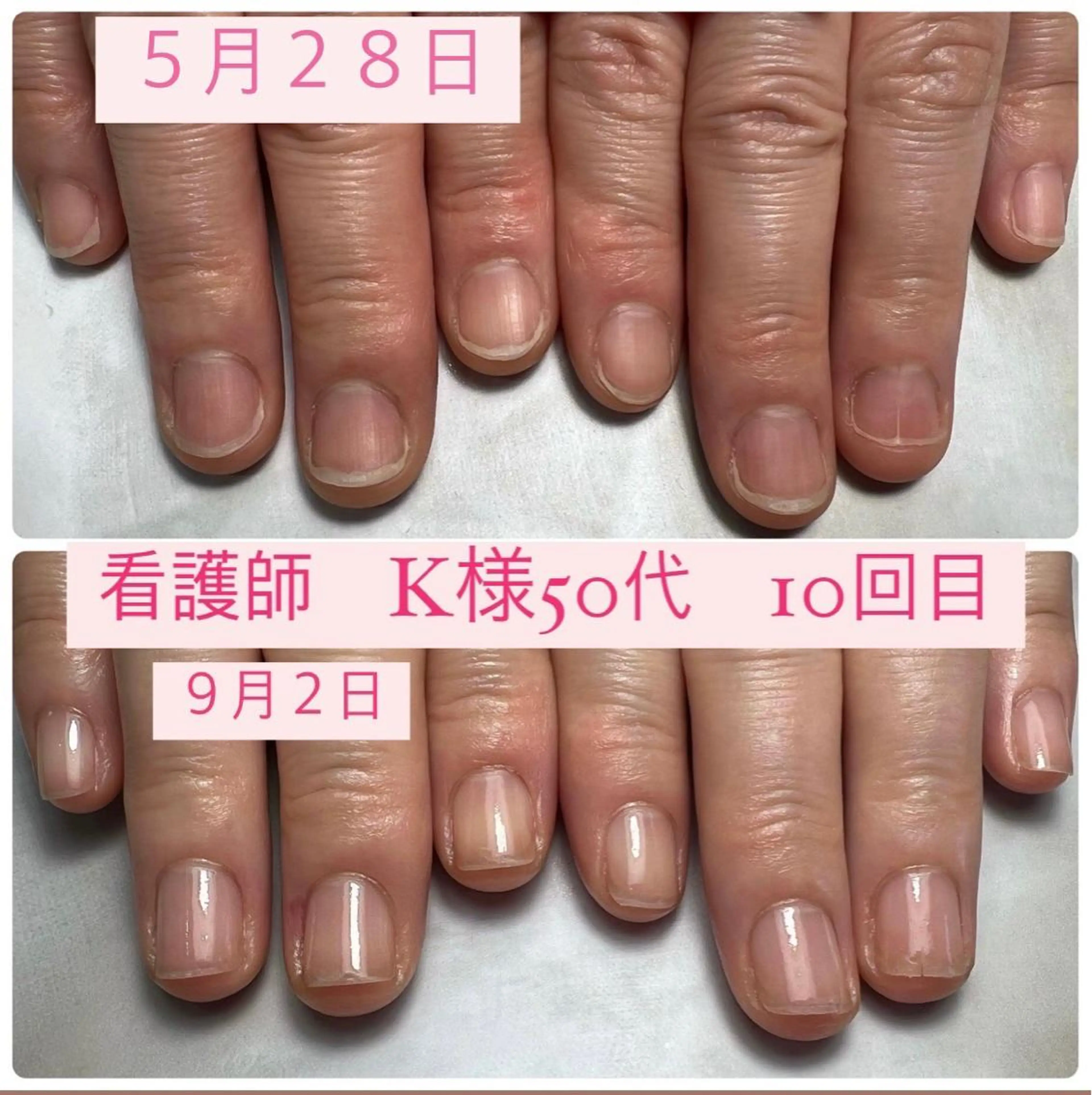 ネイル 自爪育成/深爪矯正 mikiのネイルデザイン