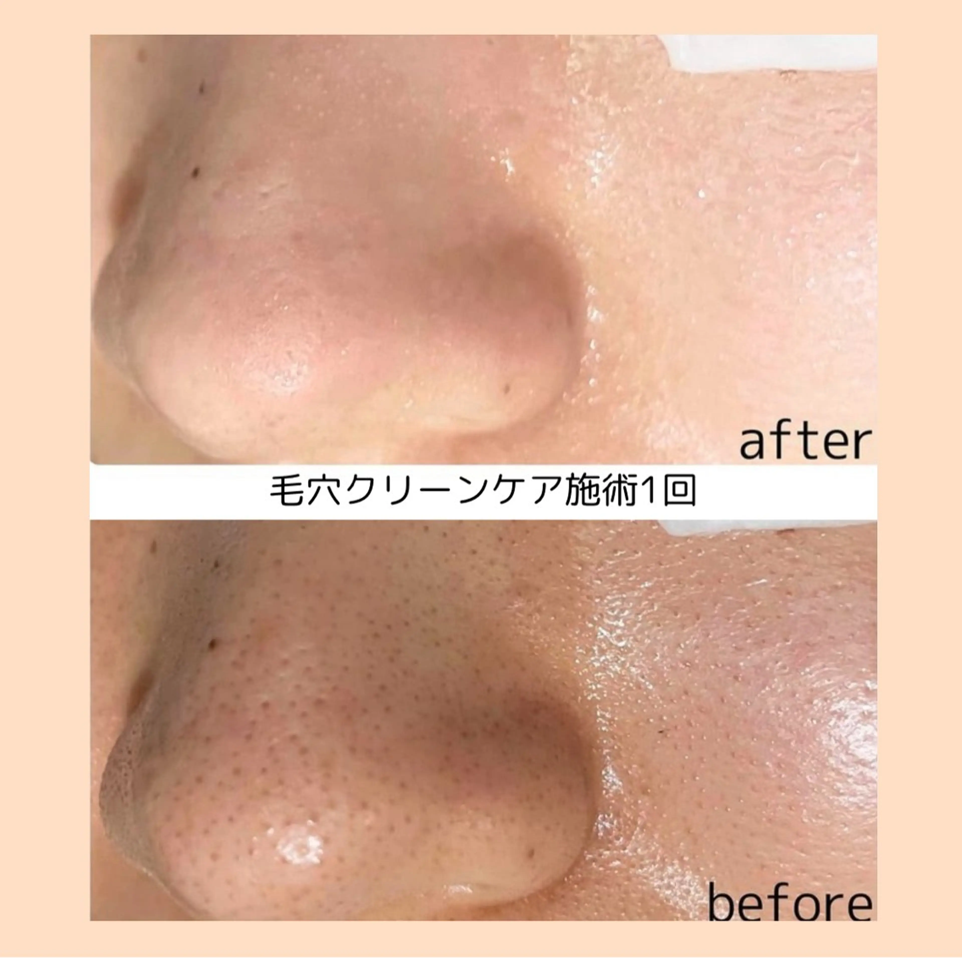 《モニター様※条件有り》毛穴クリーンケア(成長因子パック付)の写真