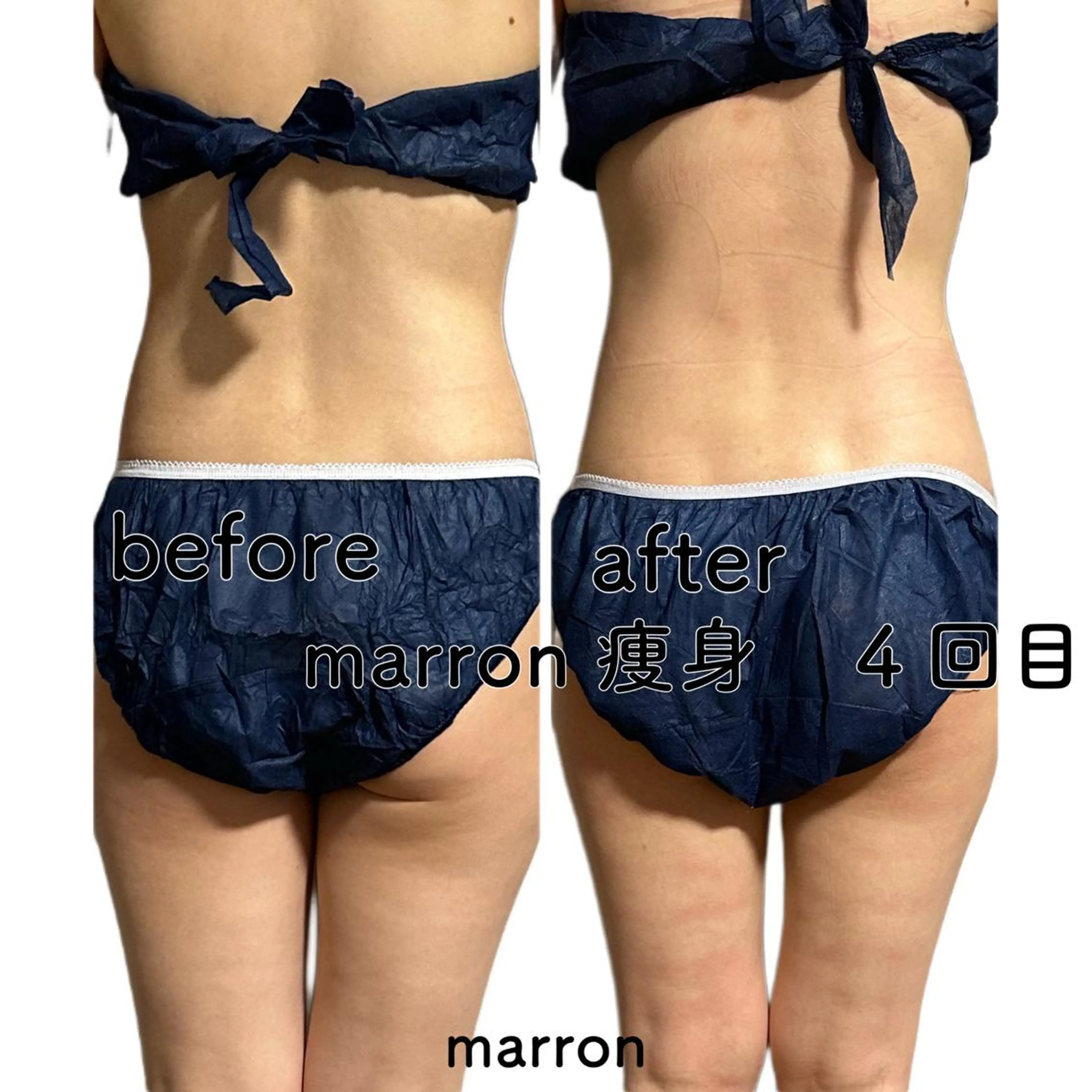 痩身ハイパーナイフ ララピールリアボーテのエステ・リラクイメージ