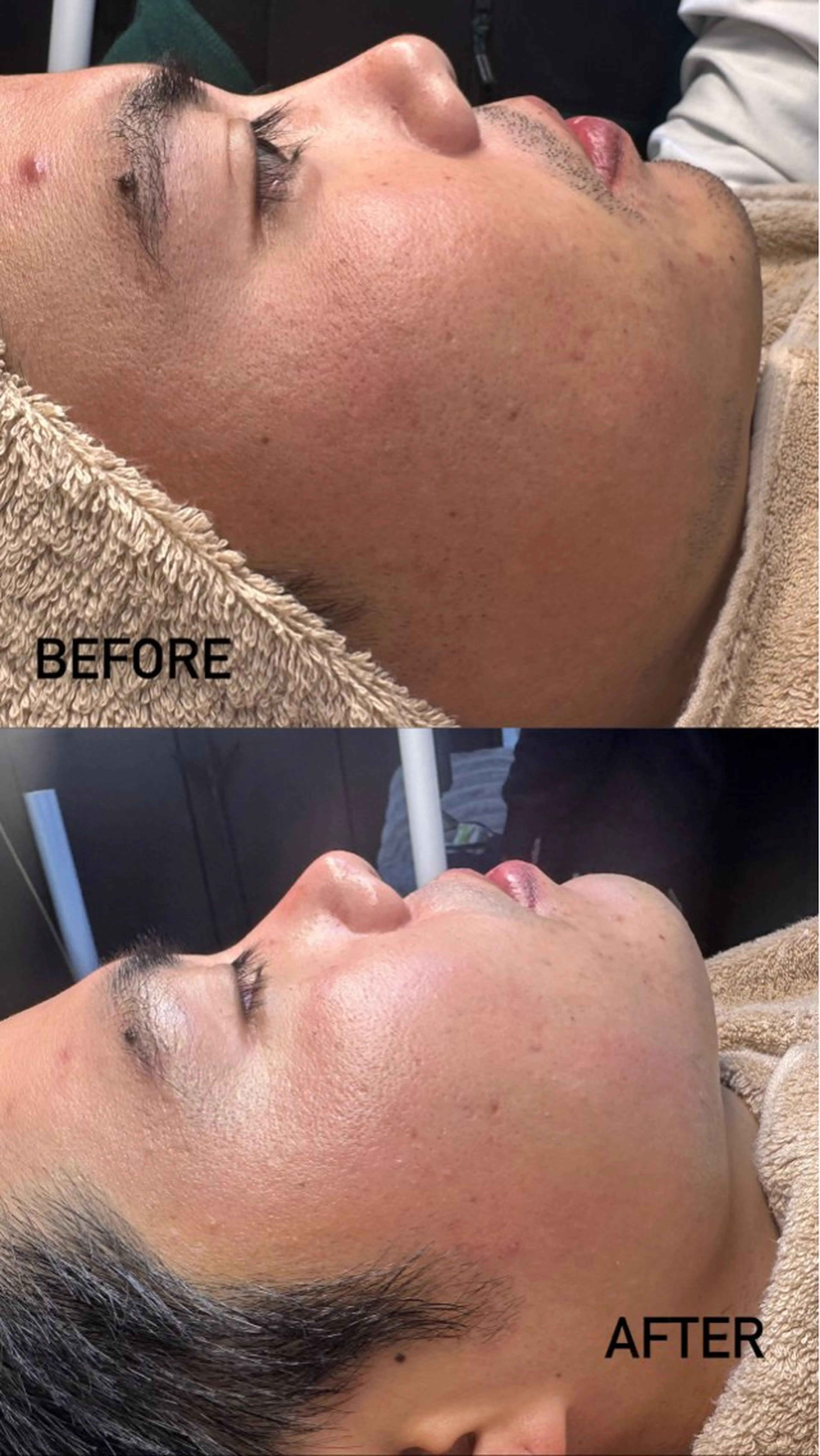 クリスティーナ ハーブピーリング🌿➕毛穴ケアの写真