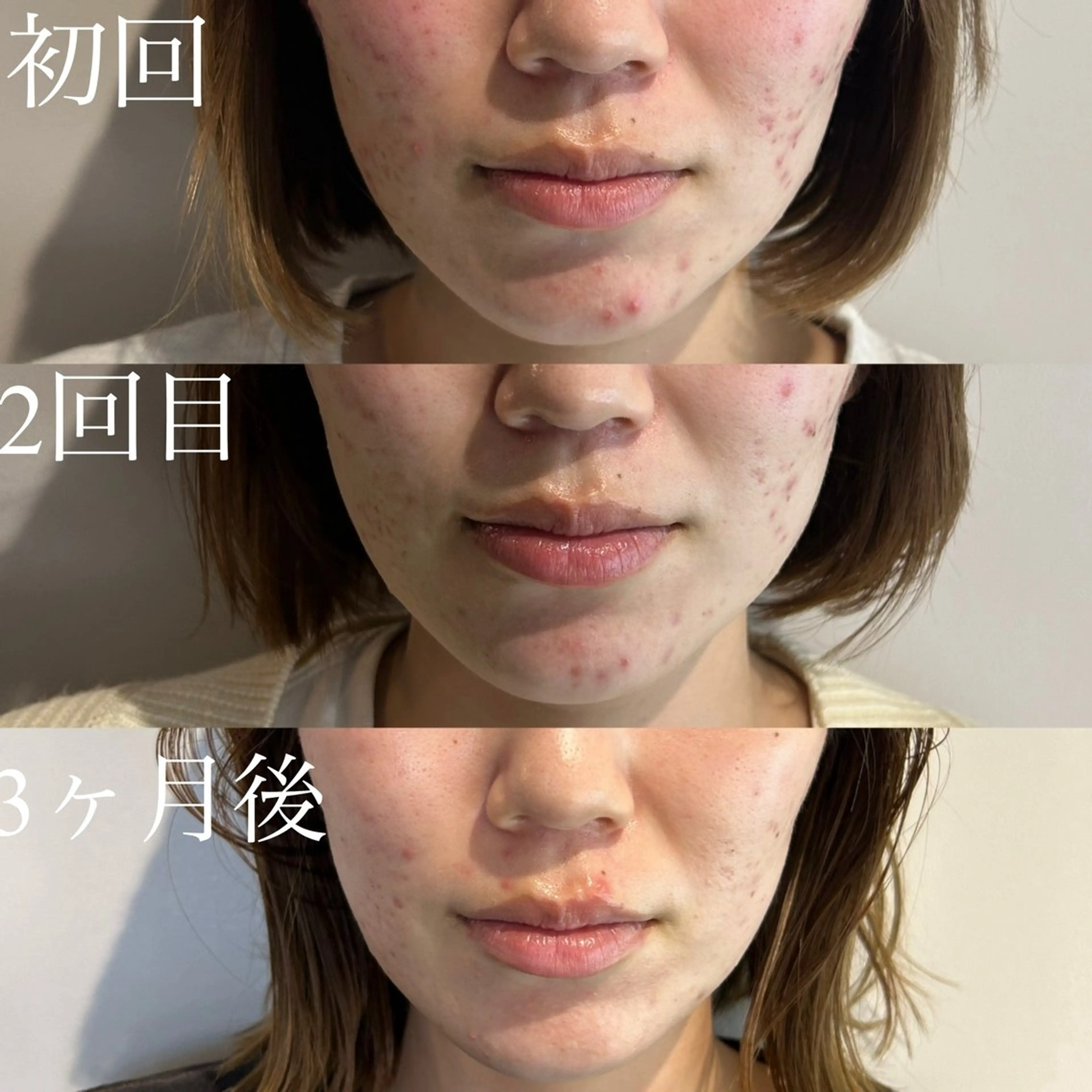 👶🏻気になる肌のエイジングケア👶🏻毛穴洗浄×光フェイシャル×コラーゲンパックの写真