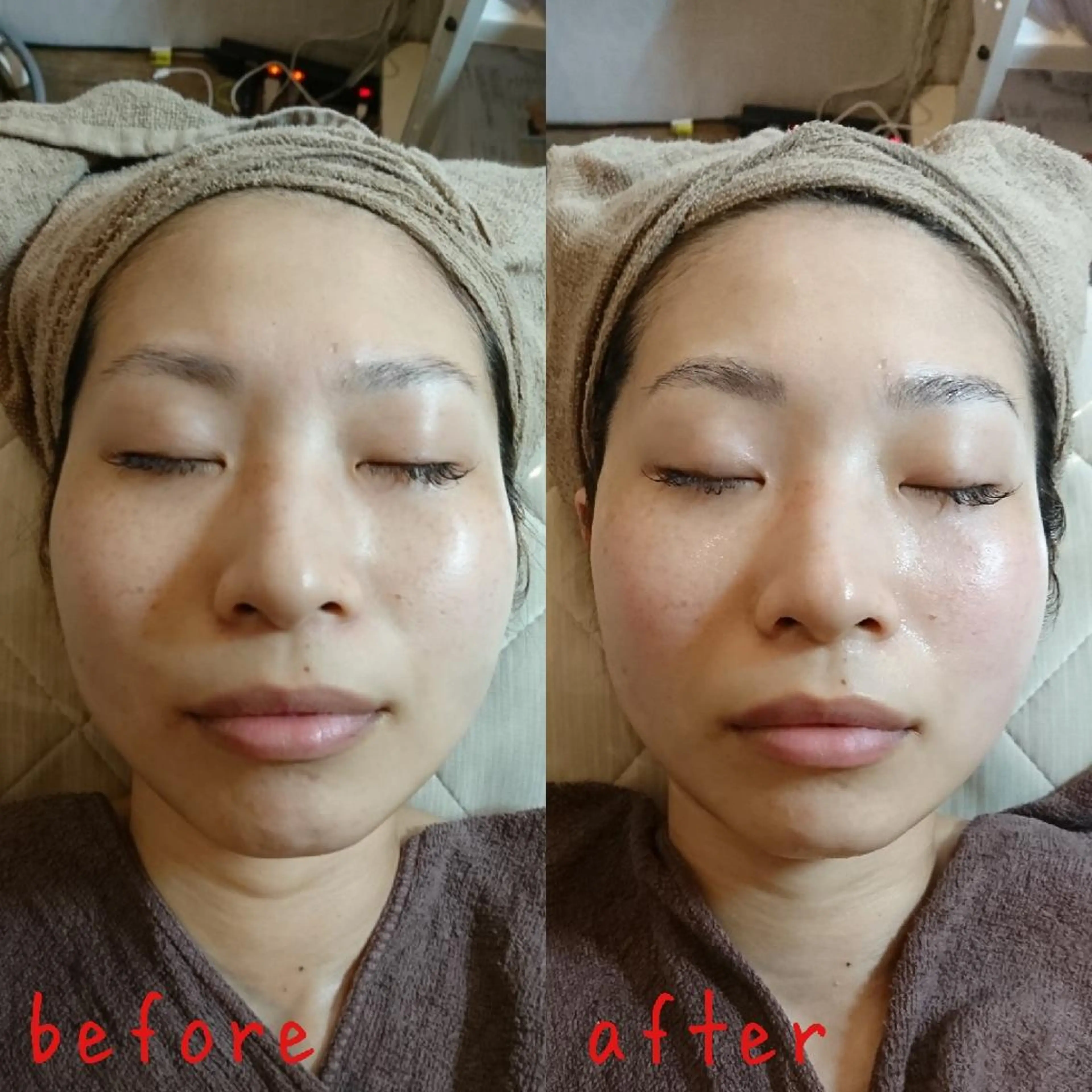 【フェイシャルエステ】ウルトラファイン炭酸バブル★洗浄効果・くすみ・透明感の写真