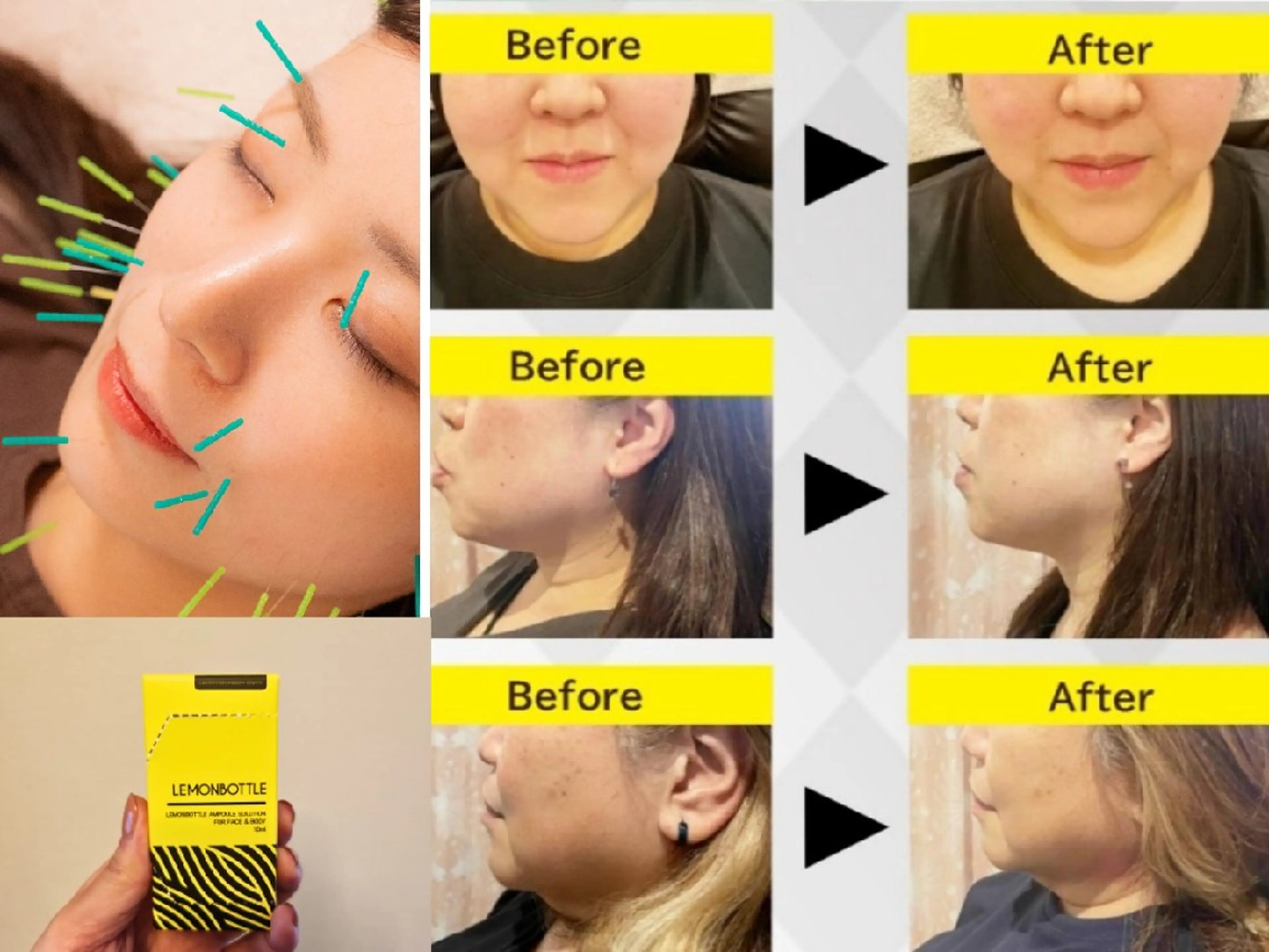 その他 即効⚡小顔美容鍼🪡 むくみたるみ脂肪解消のエステ・リラクイメージ