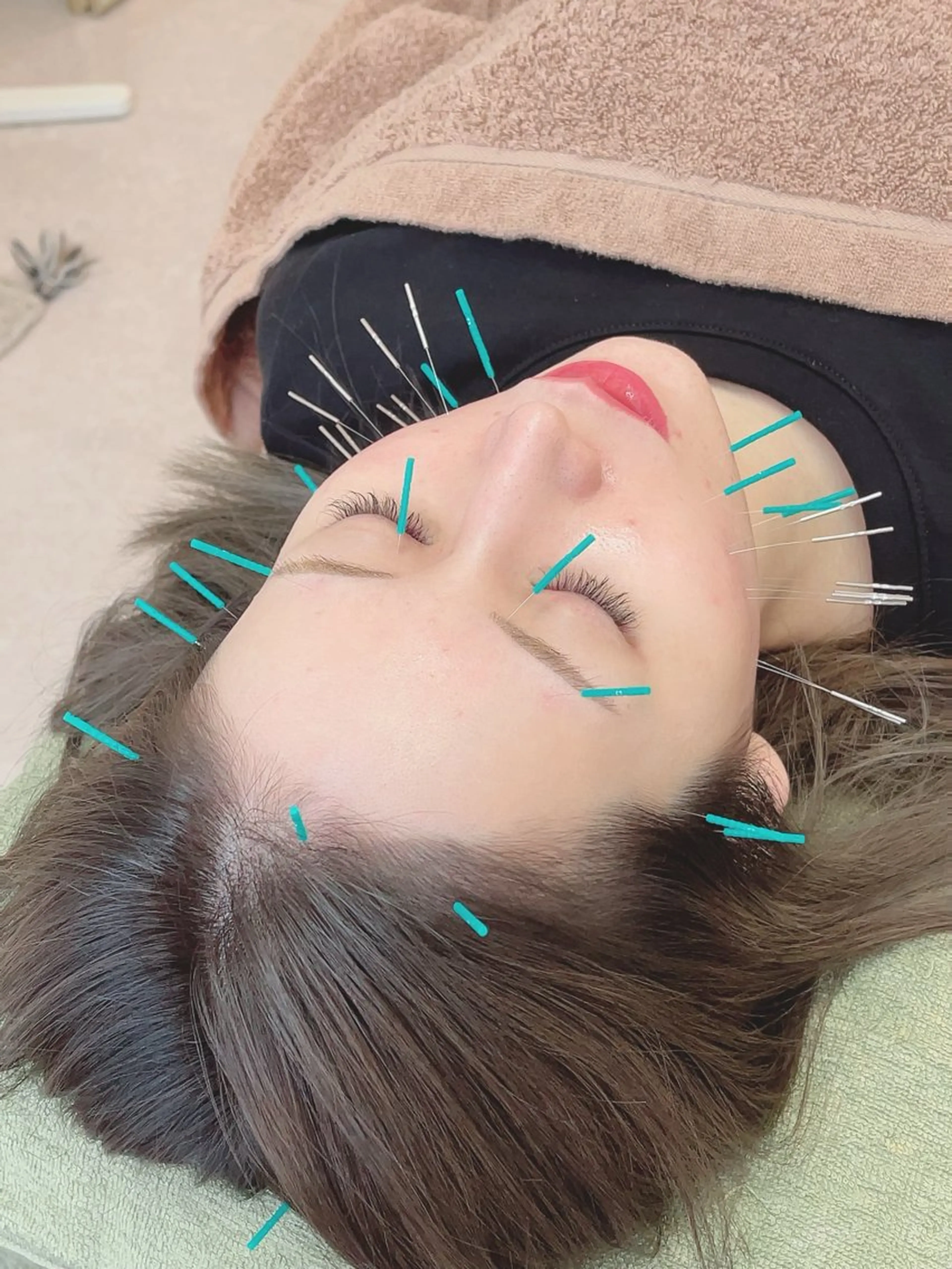 💎A-je大人気メニュー💎　毎日お一人様限定❗️【小顔矯正＋美容鍼】¥5,000の写真