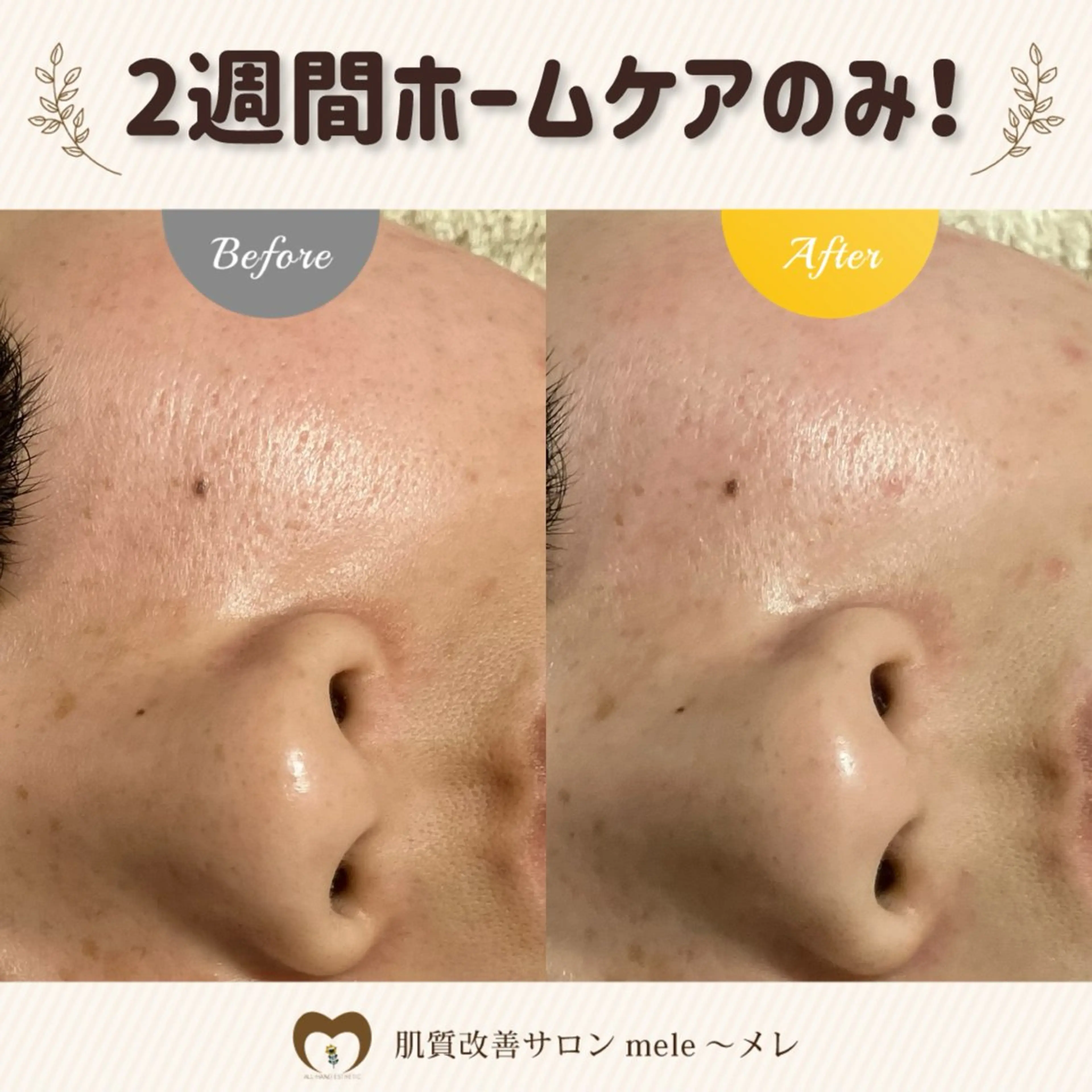 繰り返すニキビ・毛穴 ✨つくば肌質改善専門のエステ・リラクイメージ