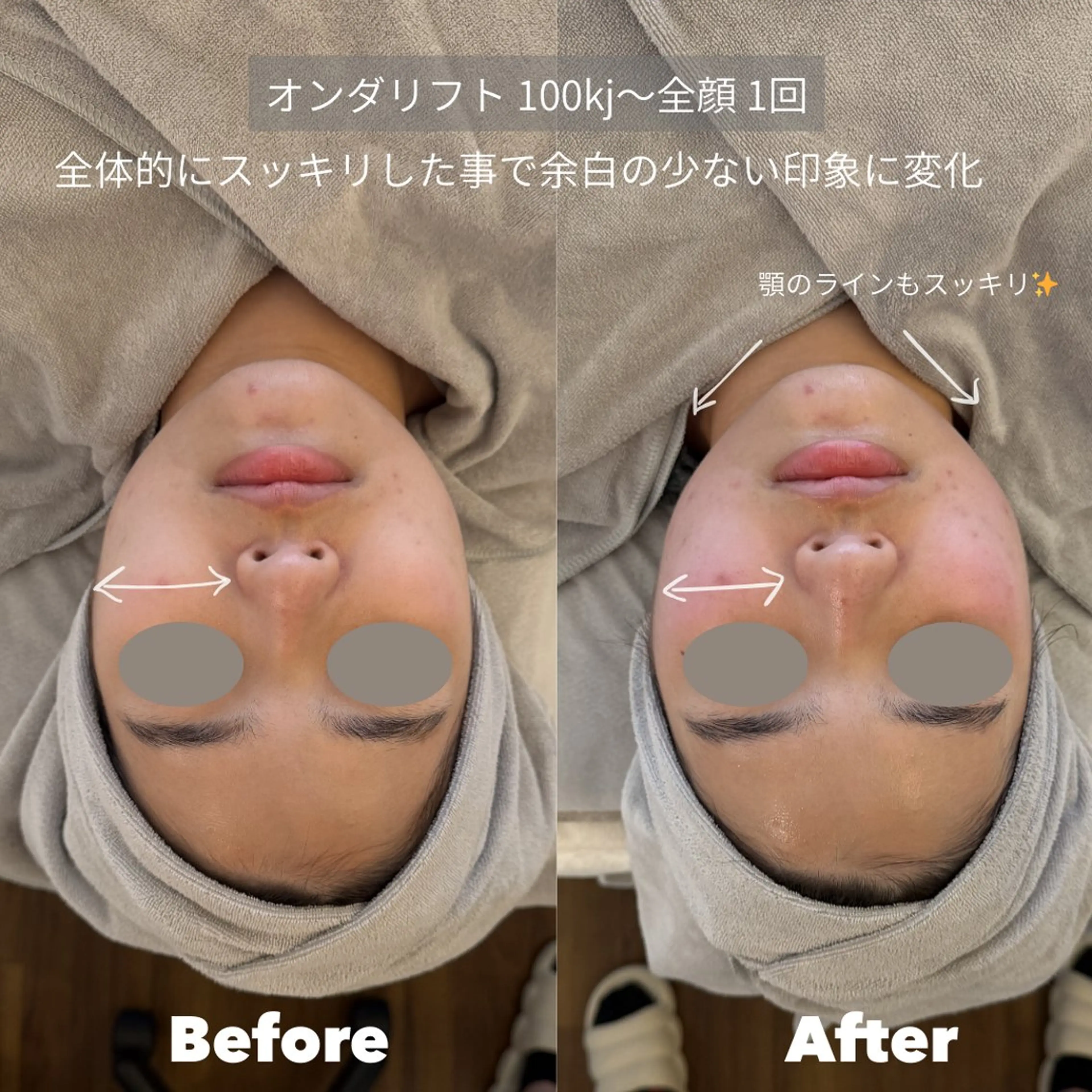 エステ 恵比寿 オンダリフト 小顔ケアのその他イメージ