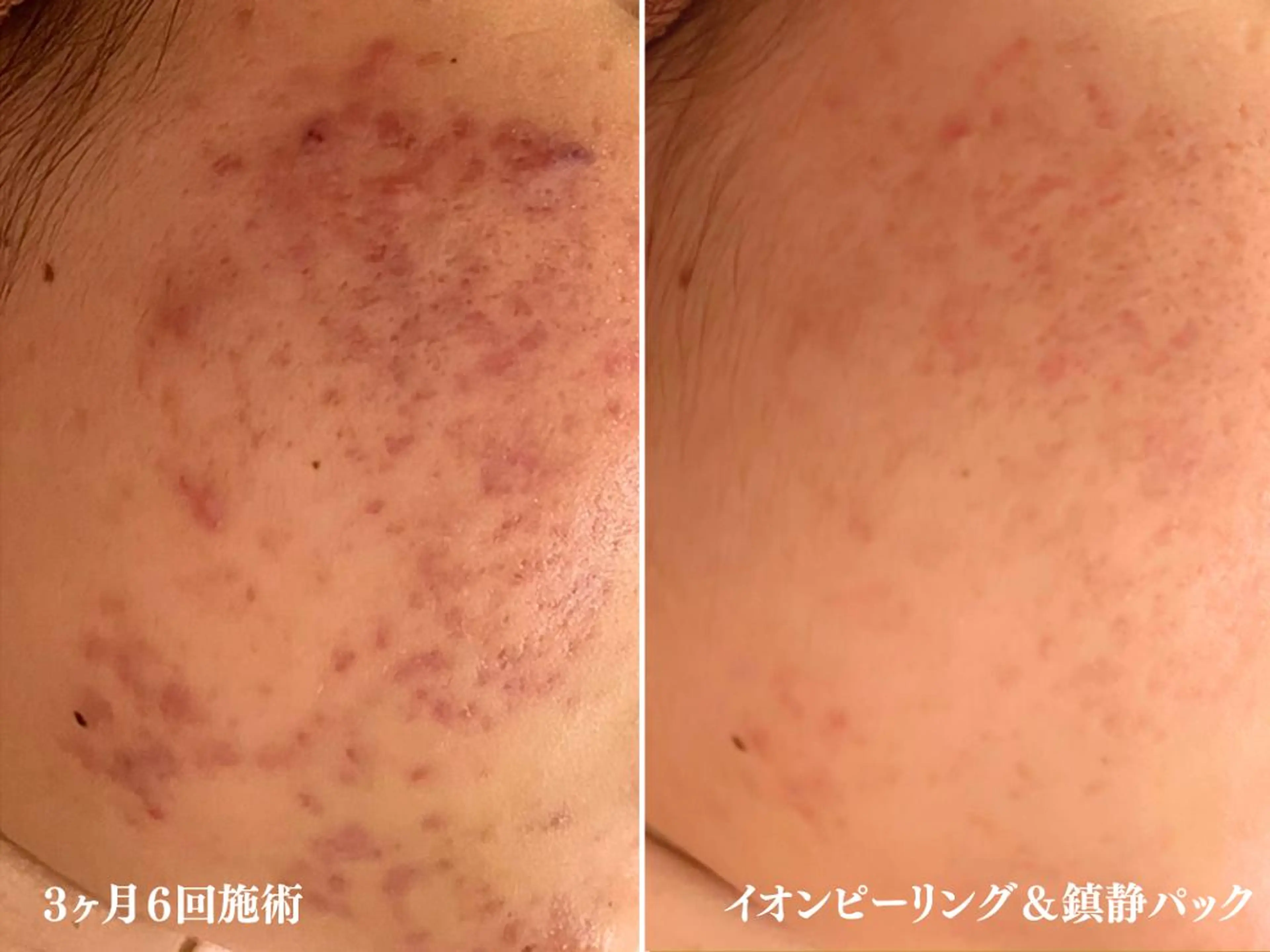 エステ リラク 3か月で肌革命👼 ニキビ専門店💫のエステ・リラクイメージ