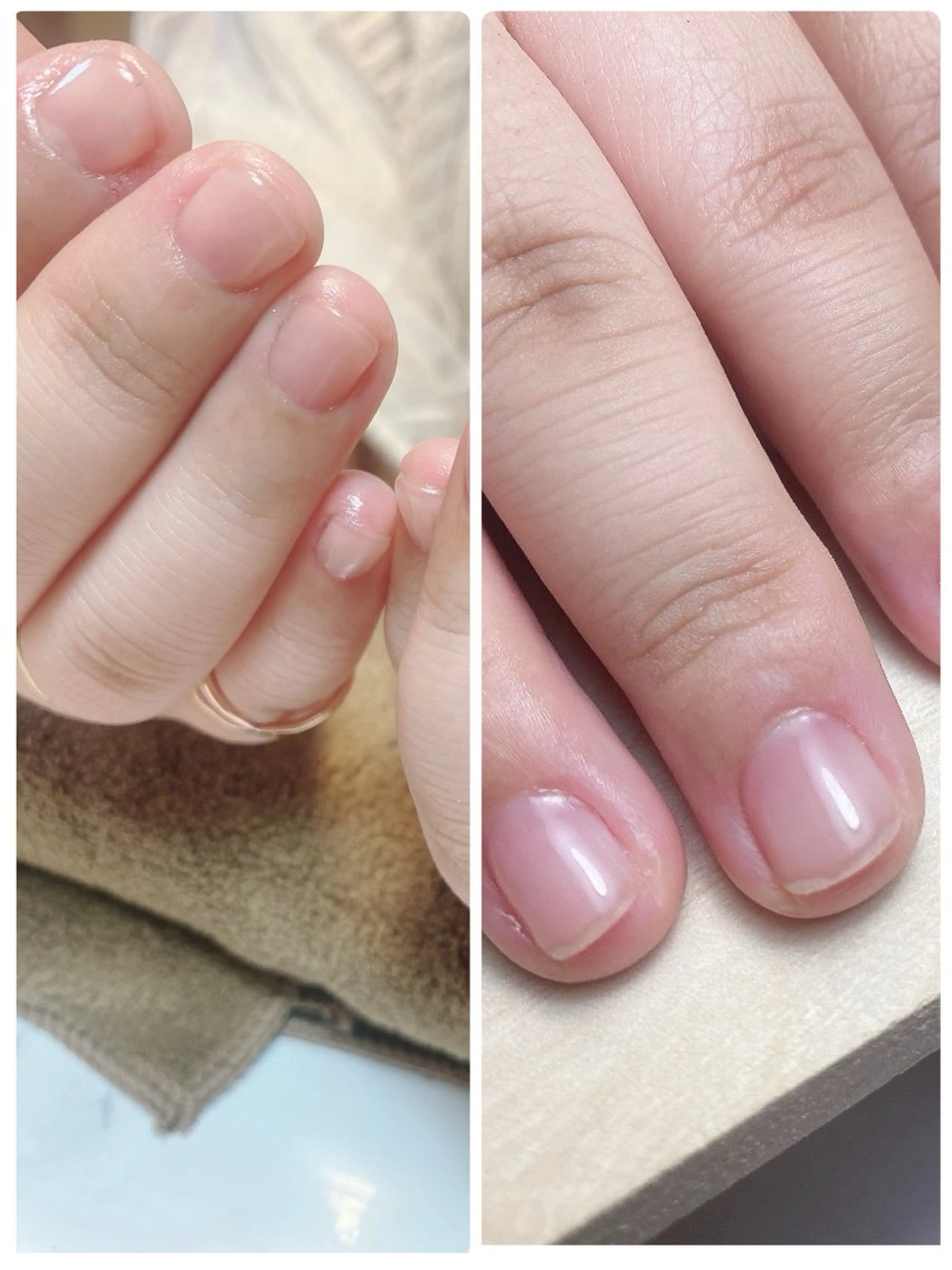 自爪育成ケアの写真