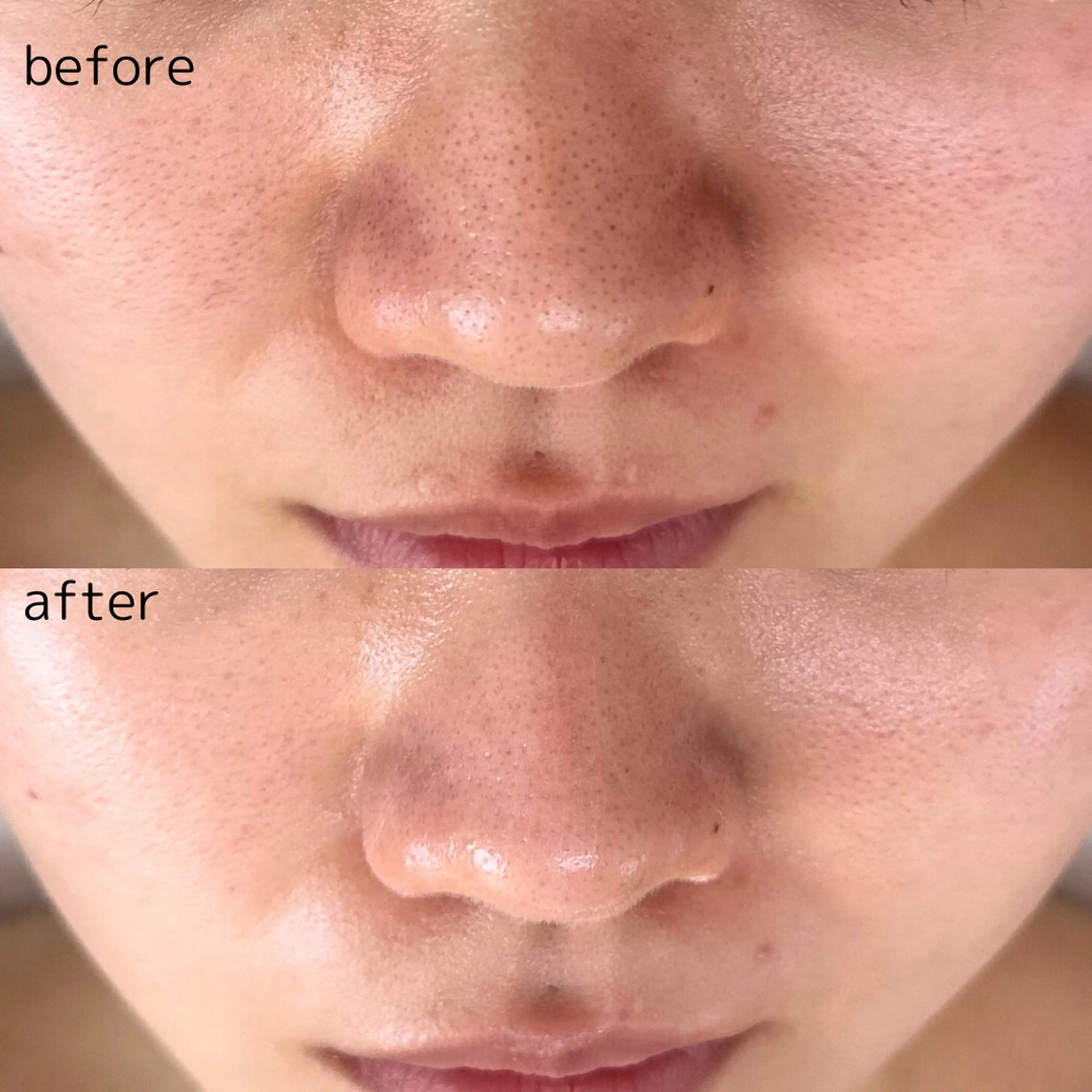 ツルツル毛穴レス韓国肌ハーブピーリング🩷デコルテケア付きの写真