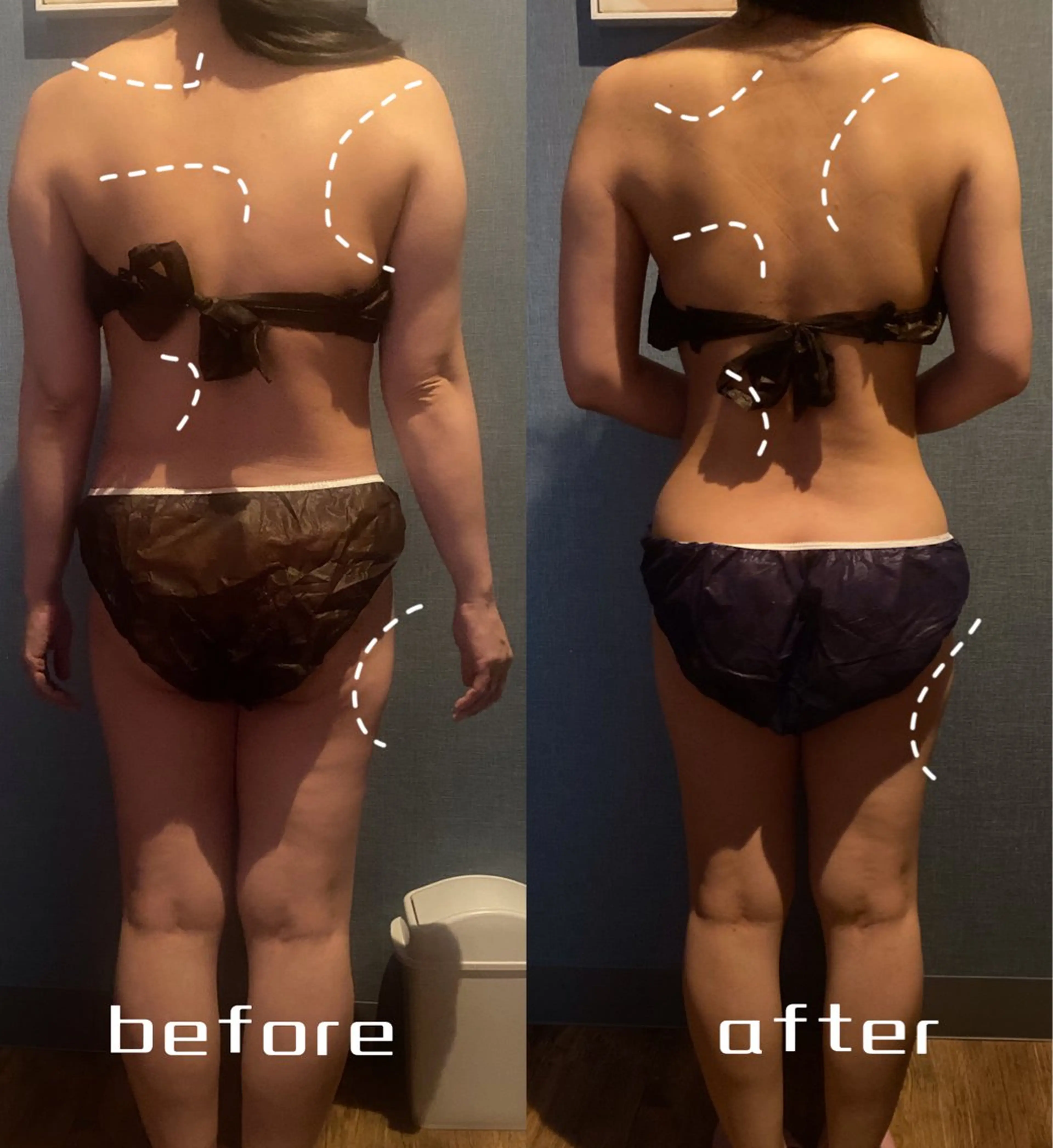 全身満遍なく🔥最新ハイパーナイフ6全身かけ放題120分の写真