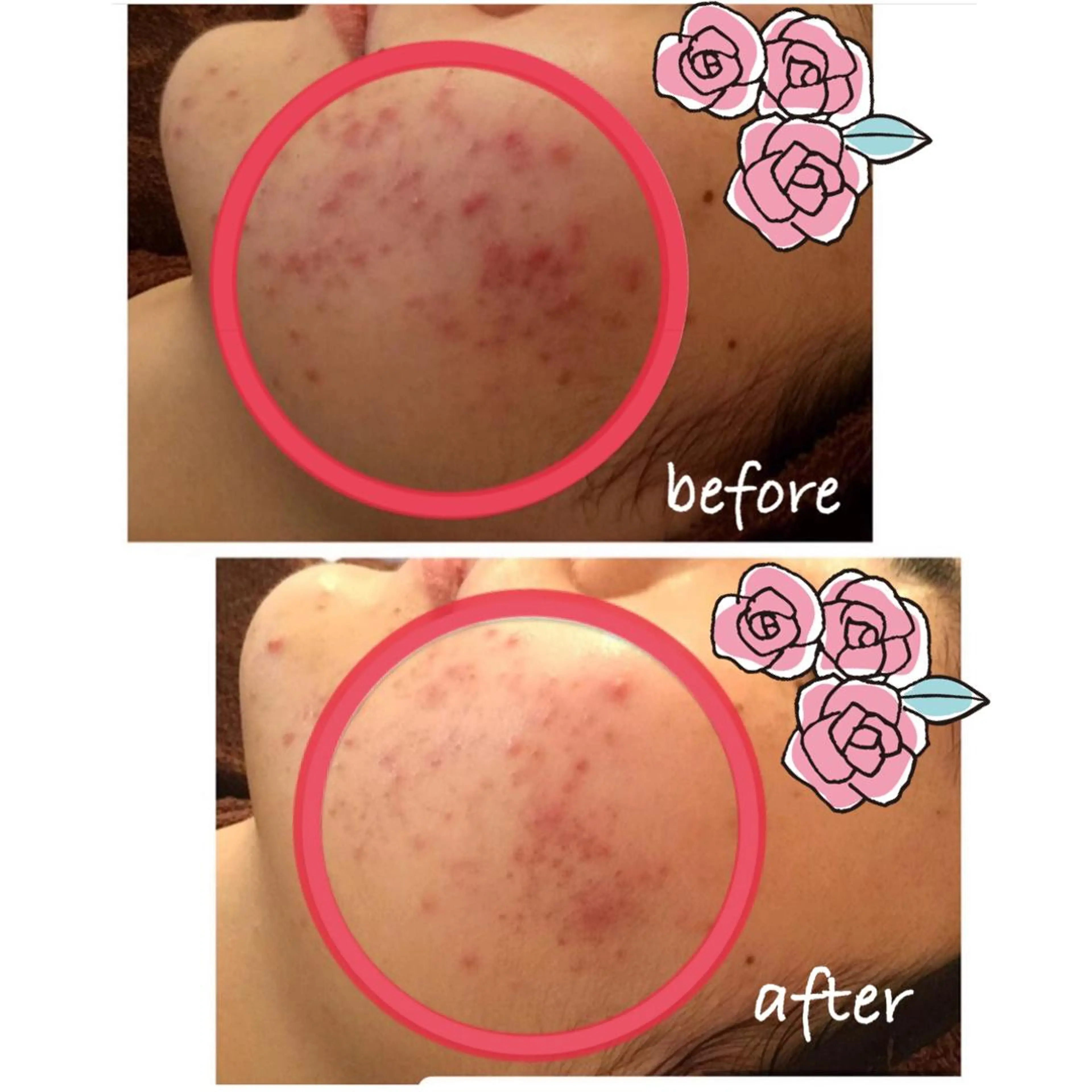 肌再生🌿ハーブピーリング(ハイドラ付き)の写真