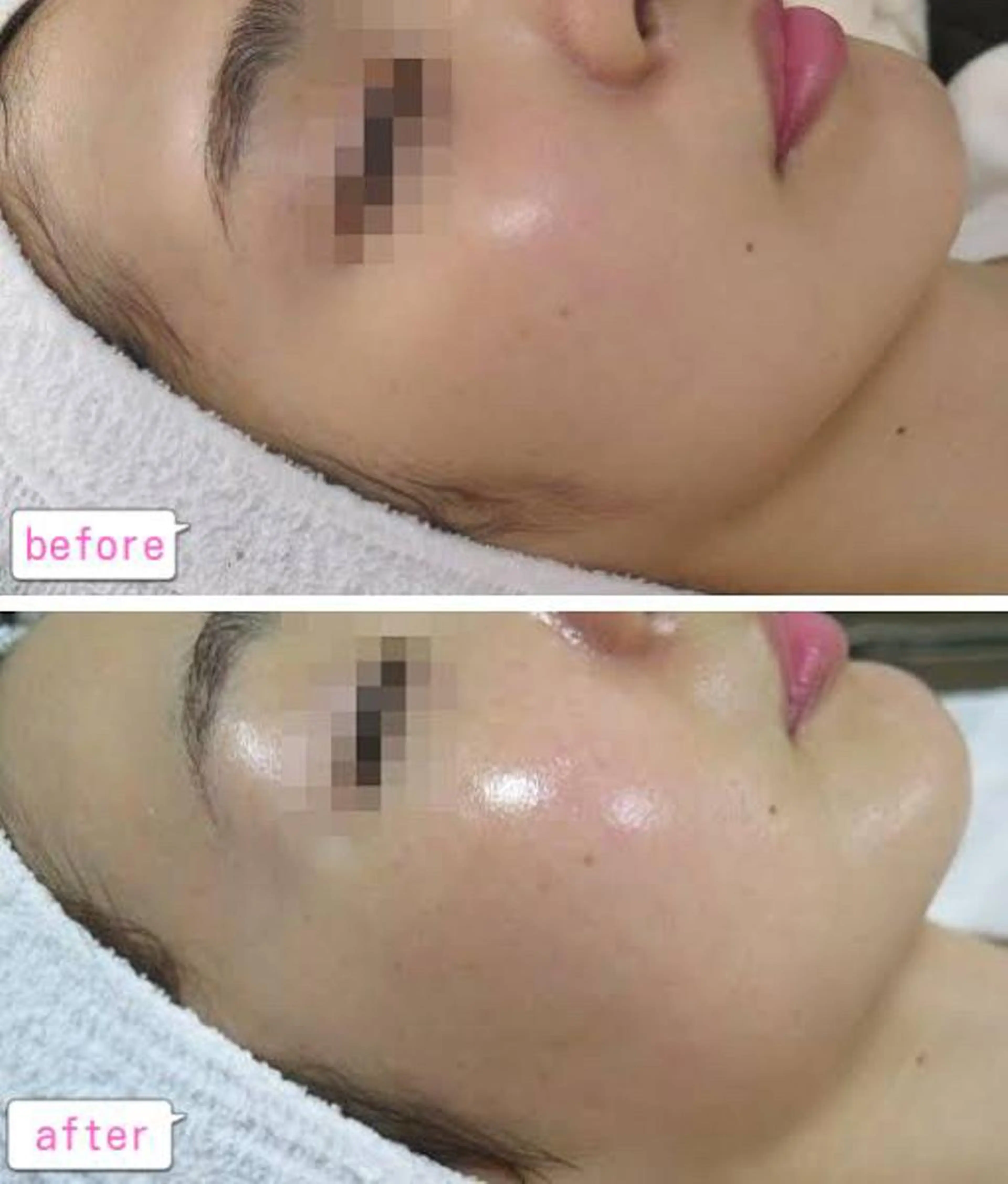 ＼お肌の大掃除🧼／ツルツルピカピカ肌質改善-ワックス脱毛🧼フェイスWax💎ワックス脱毛💎フェイシャルワックス💎の写真