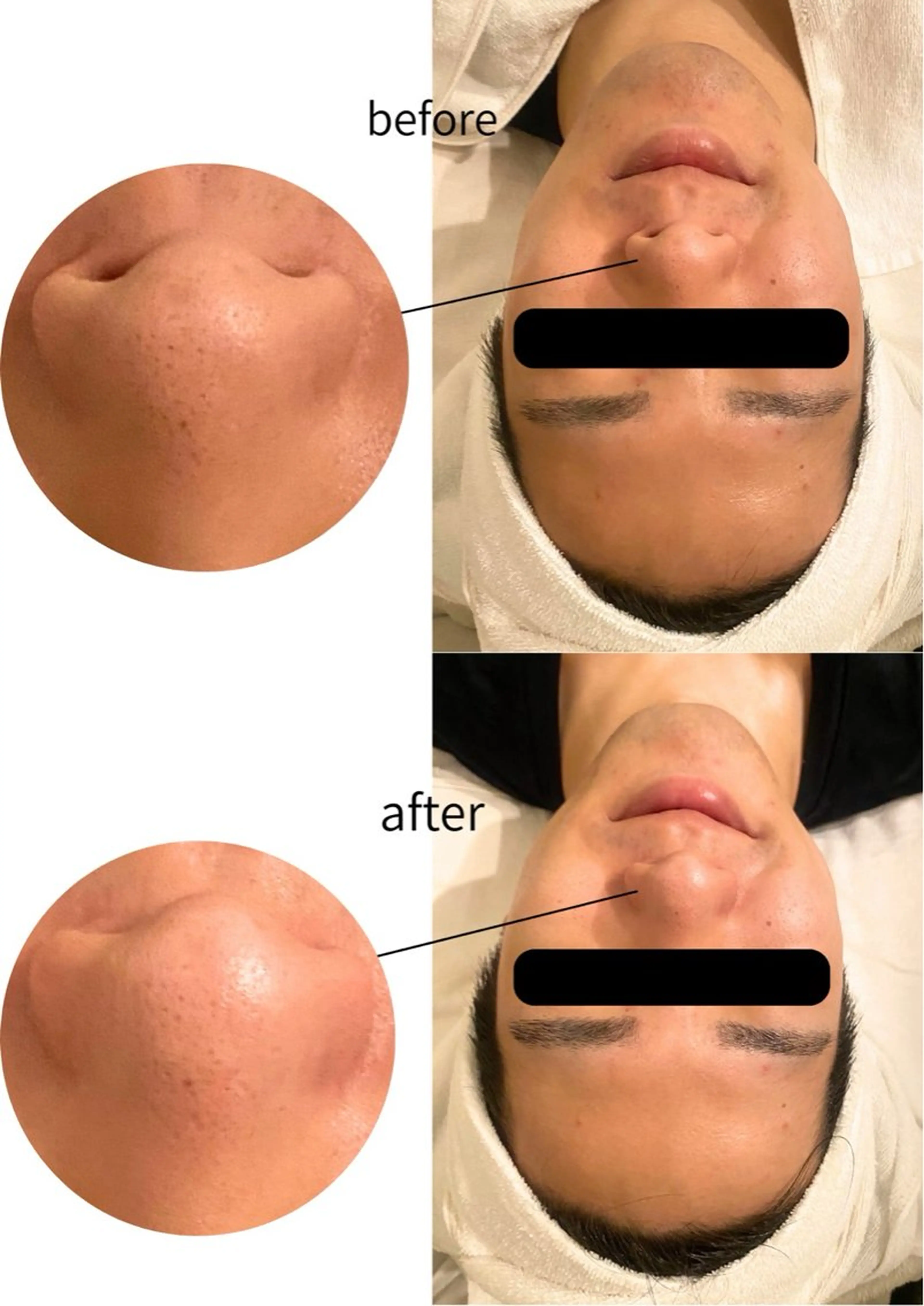 エステ リラク 韓国/ピーリング 毛穴洗浄/POLAのエステ・リラクイメージ