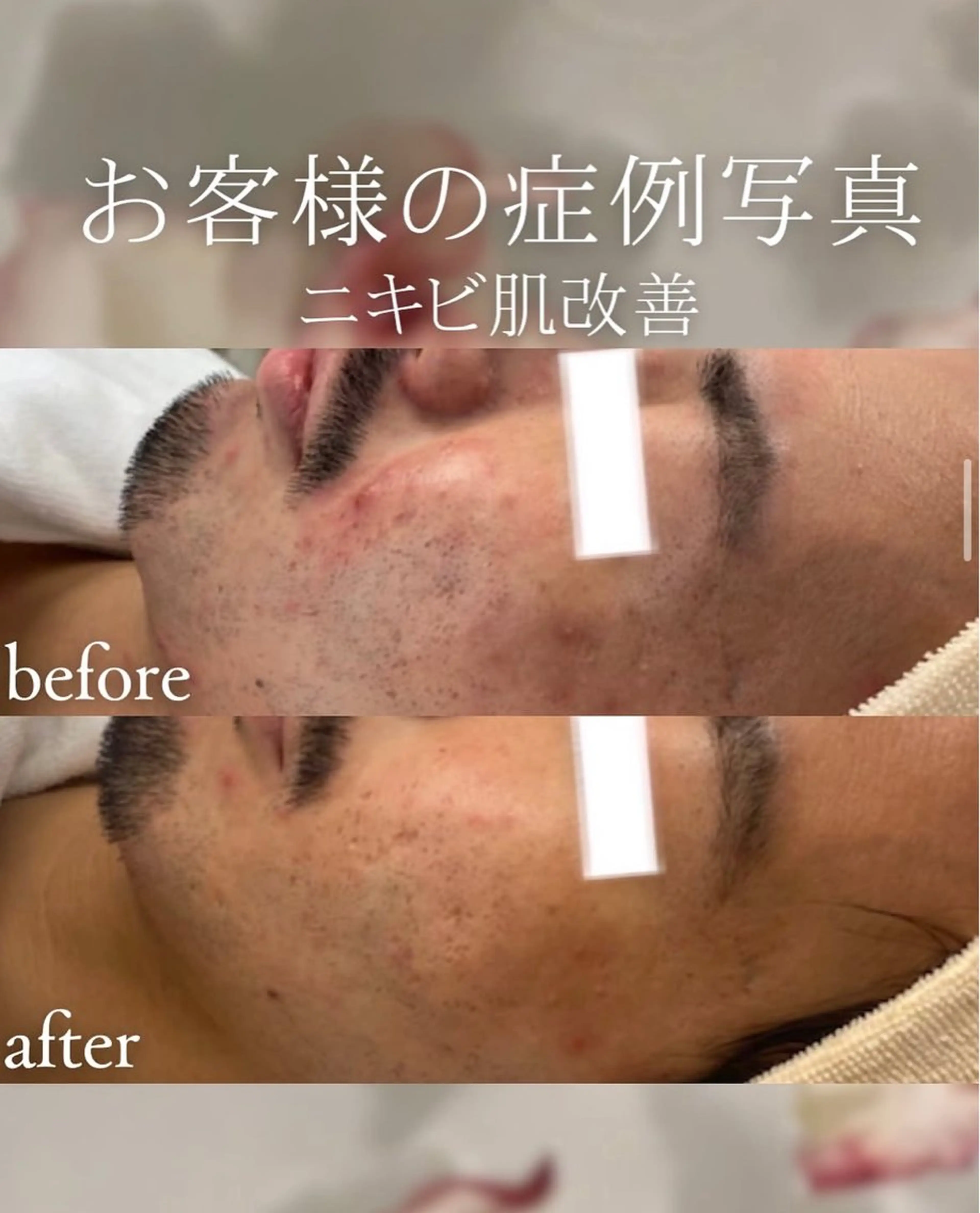 【U35 男性限定】メンズフェイシャル始動☆毛穴・ニキビコースの写真