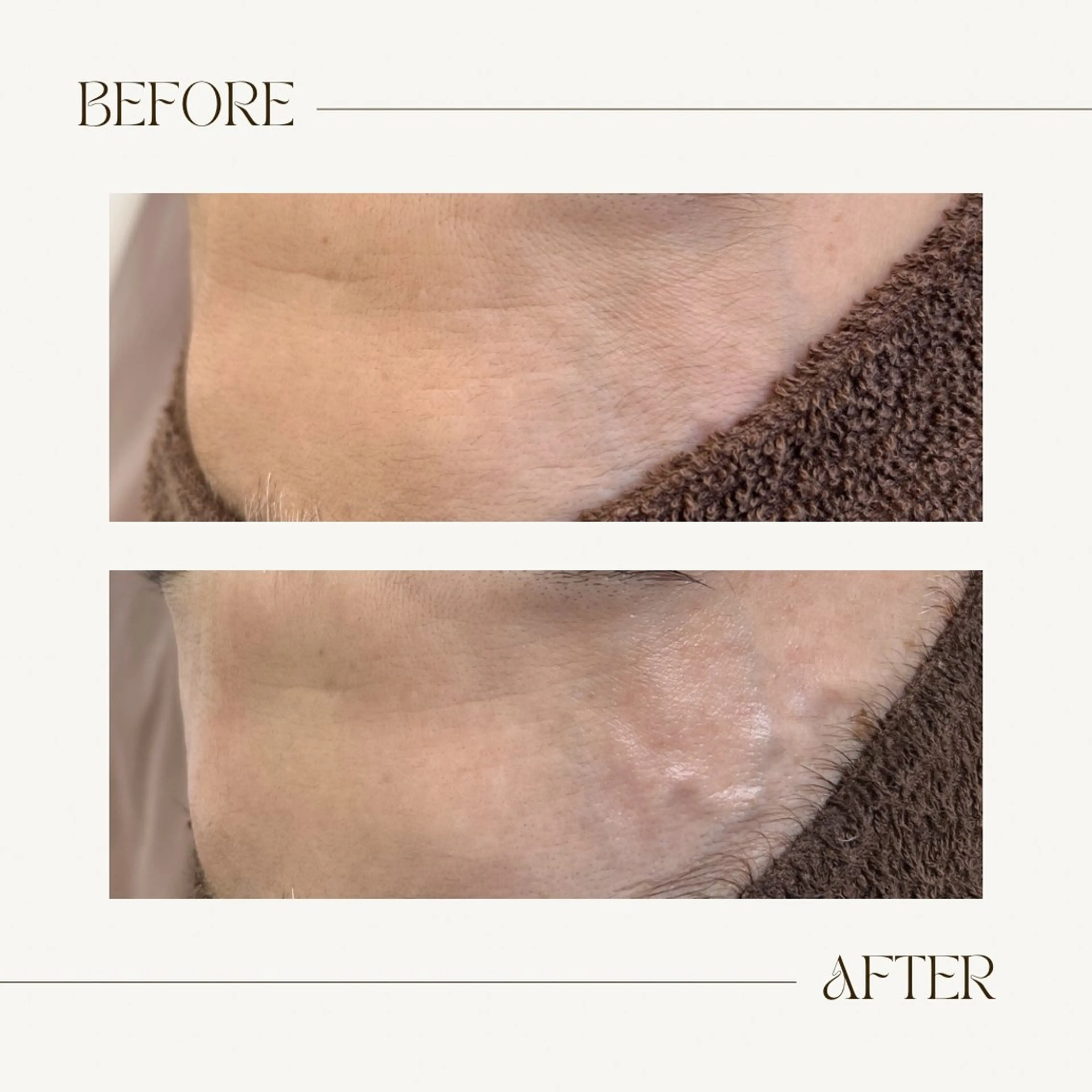 脱毛 1st｜フェイシャル エステ専門店のエステ・リラクイメージ