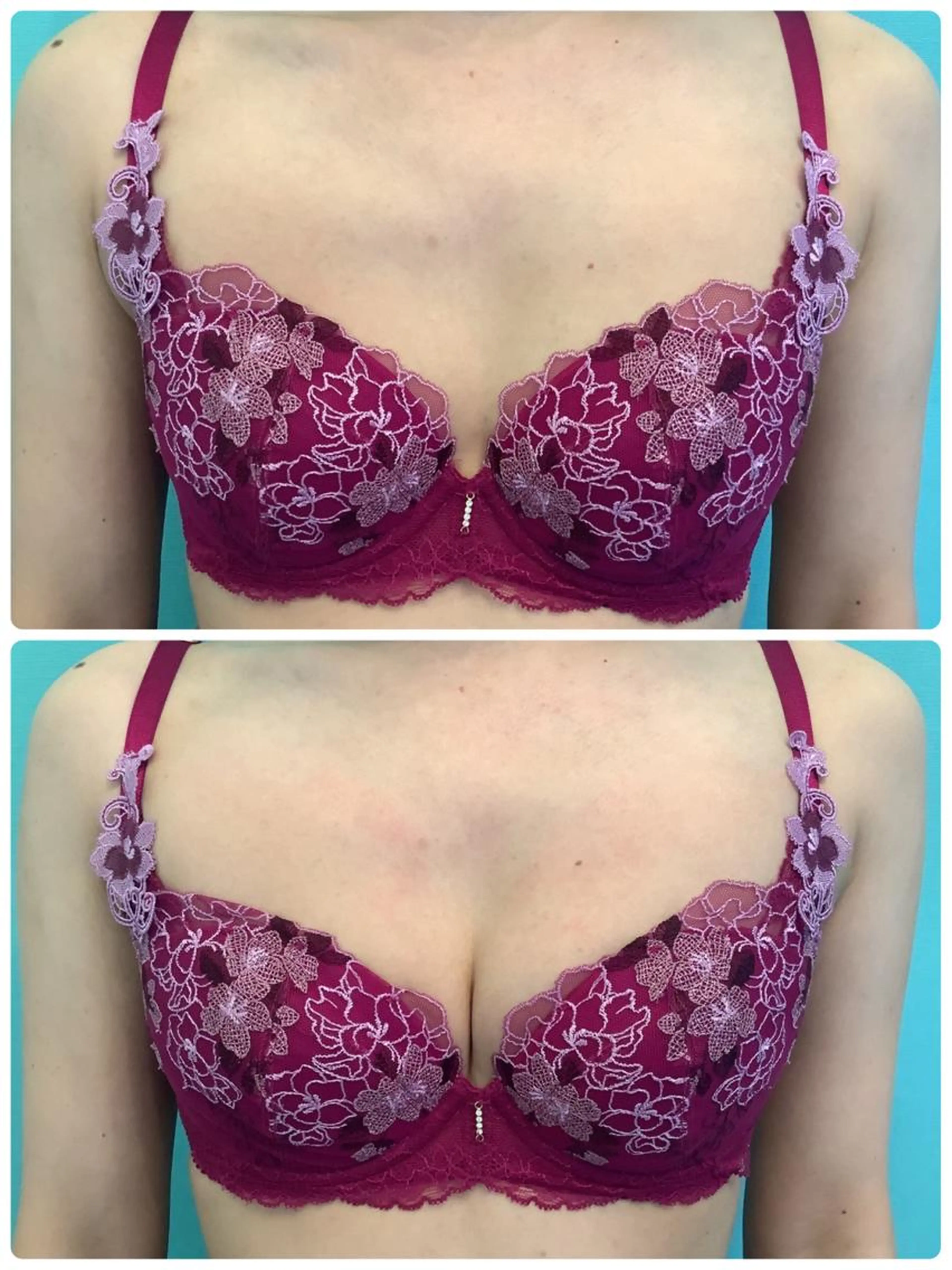 【花嫁様必見】速攻バストUP↑＆肋骨締め(脂肪増殖覚醒カクテル6ml導入の写真