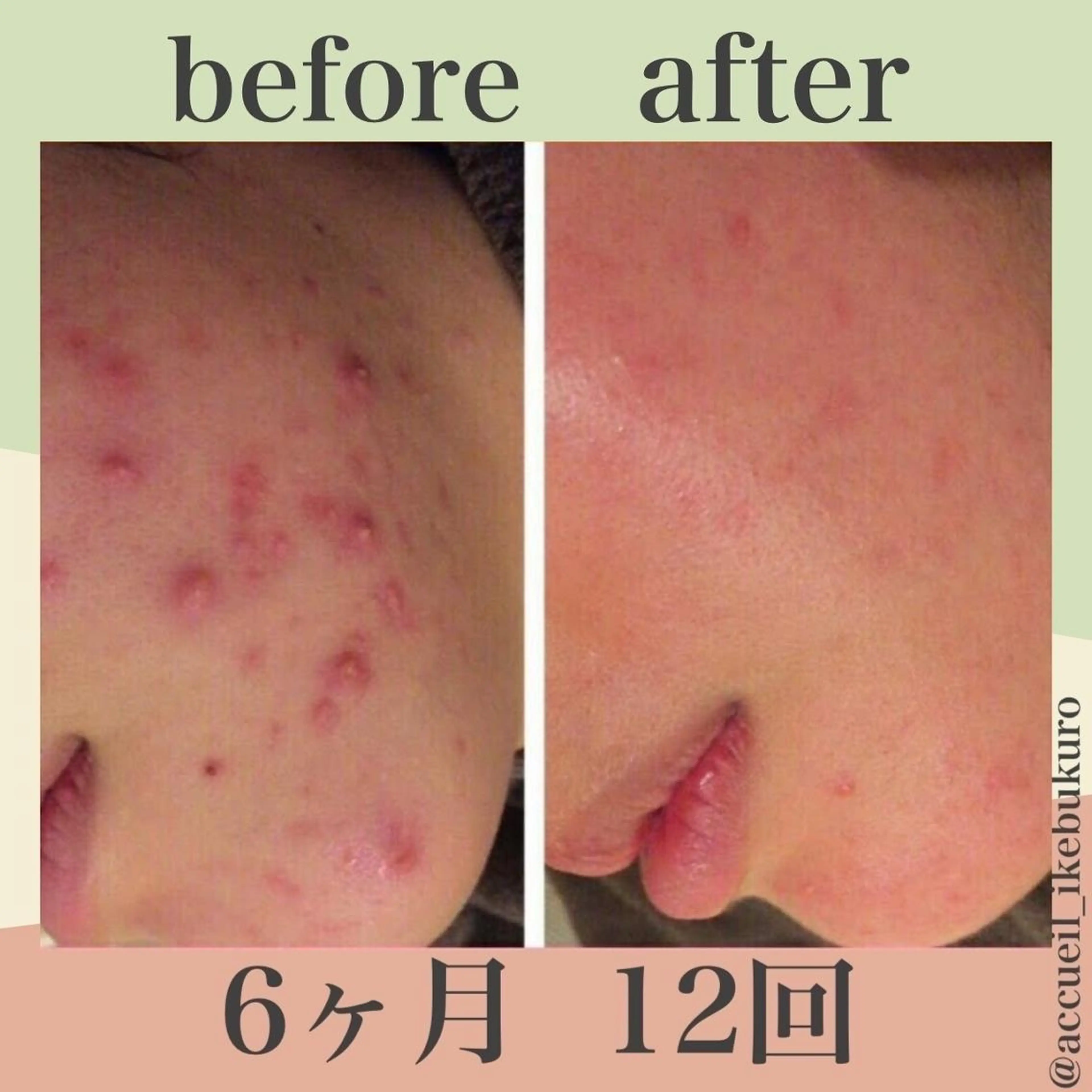 ニキビ経験者が施術 する専門サロン🌻のエステ・リラクイメージ