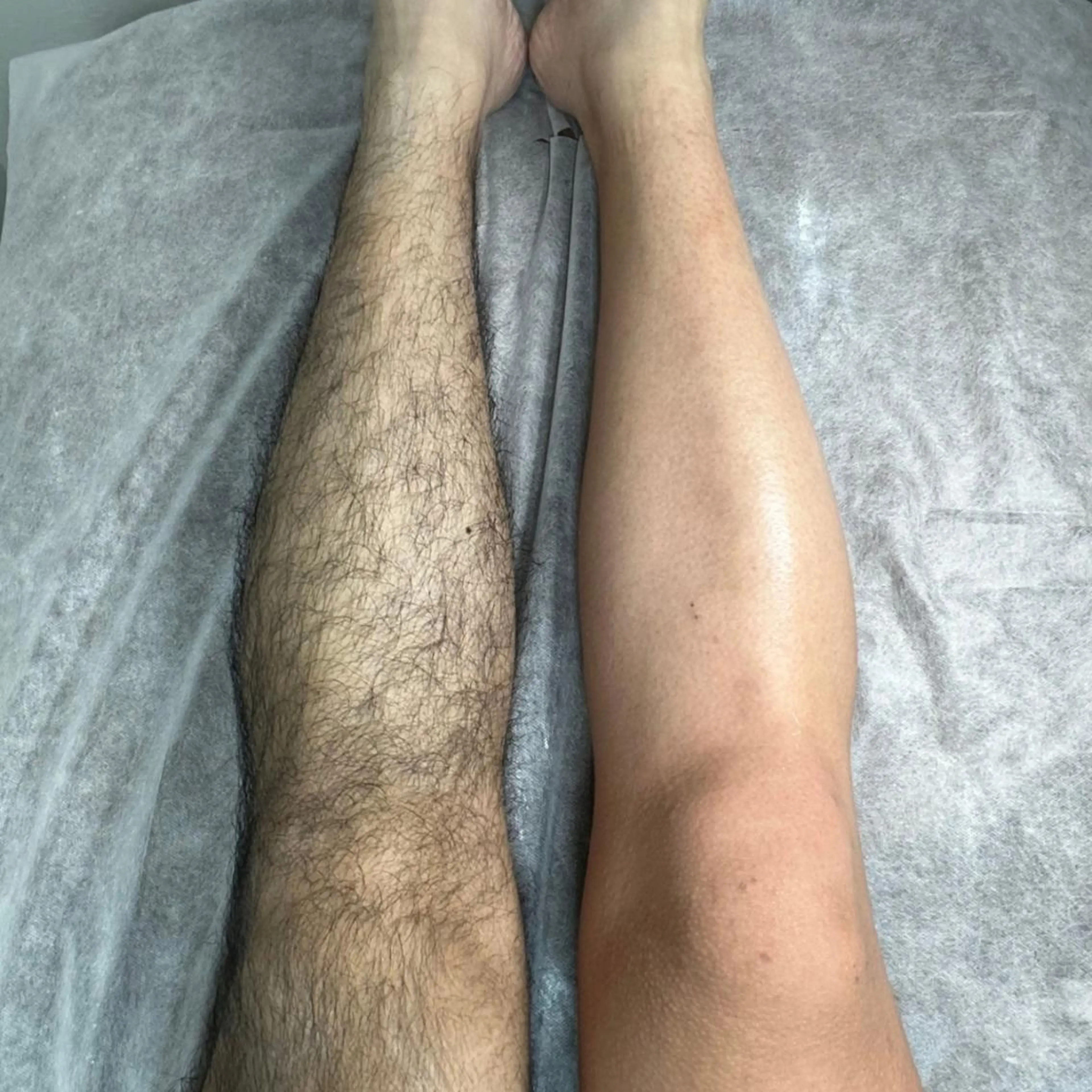 【男性】両脚ワックス脱毛✧写真モニターの写真