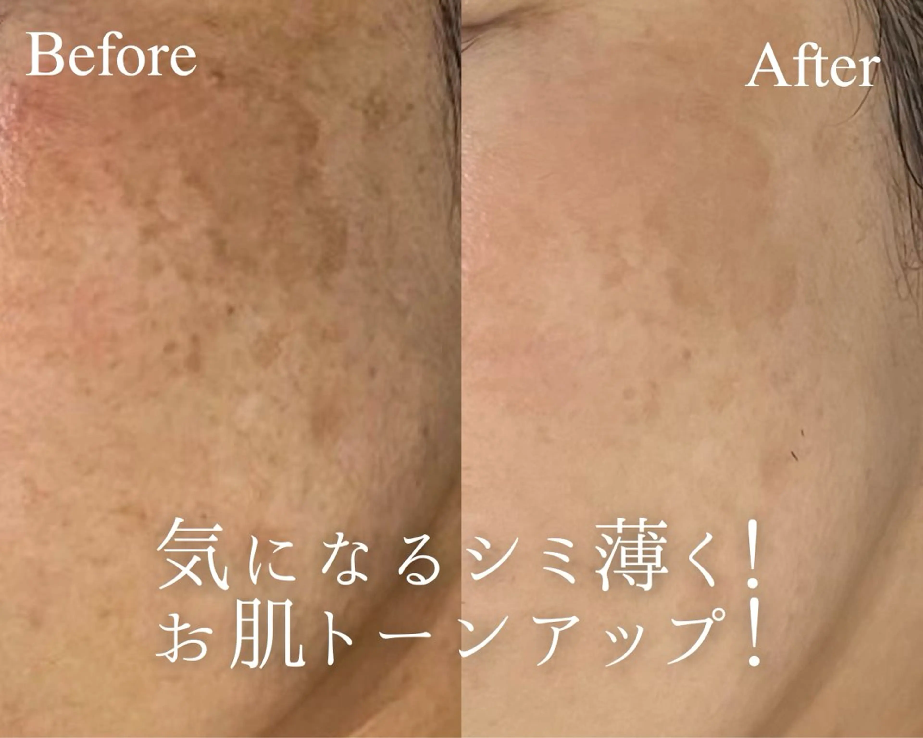 EMS×プラズマ肌質改善フェイシャル☺️💕しみ/しわ/たるみ/むくみ/くすみ/毛穴/ニキビの写真