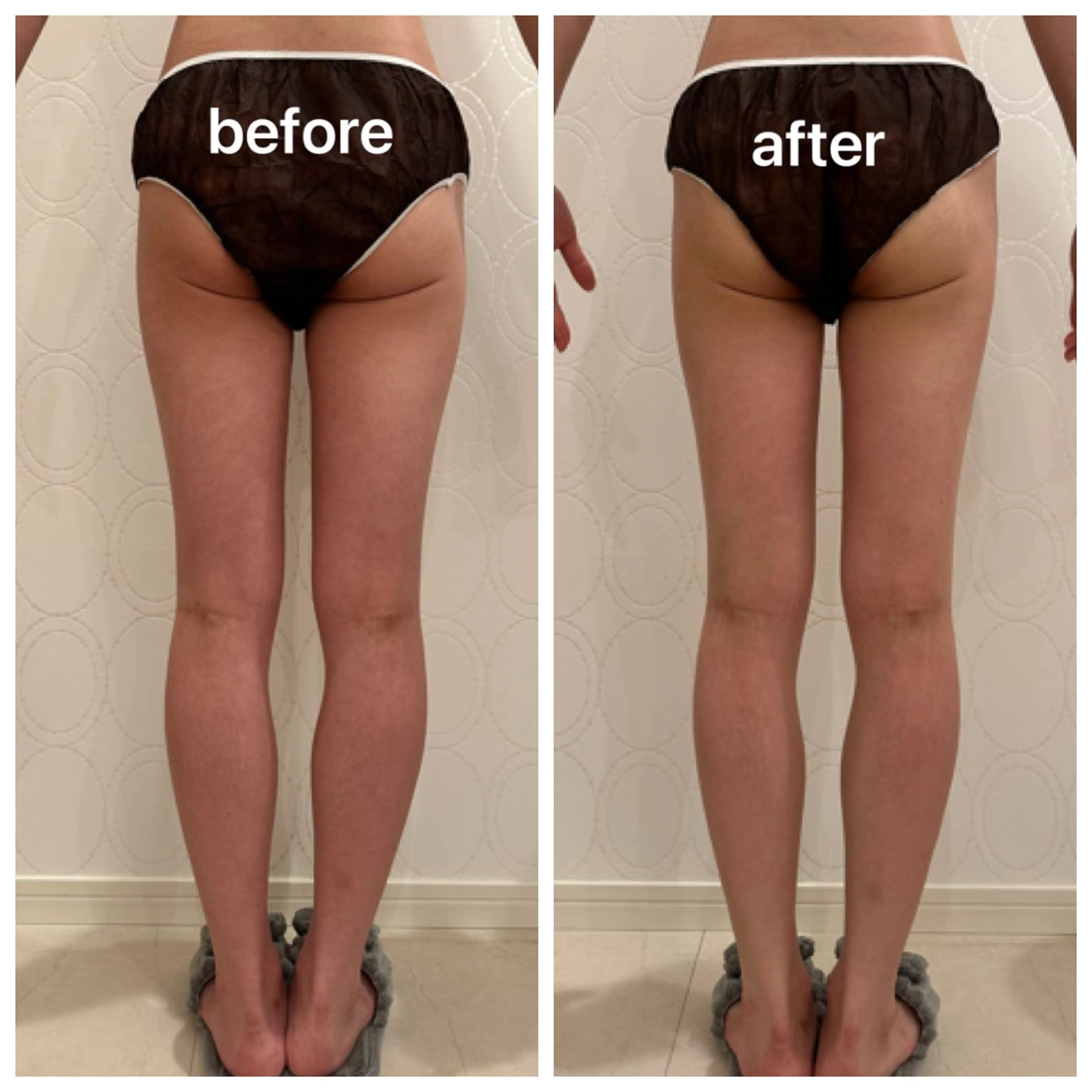 ⭐️ミニモ限定⭐️キャビテーション✖️クラッシュ吸引！下半身痩身コース（太もも表裏・ふくらはぎ）徹底セル分解ケア60分の写真