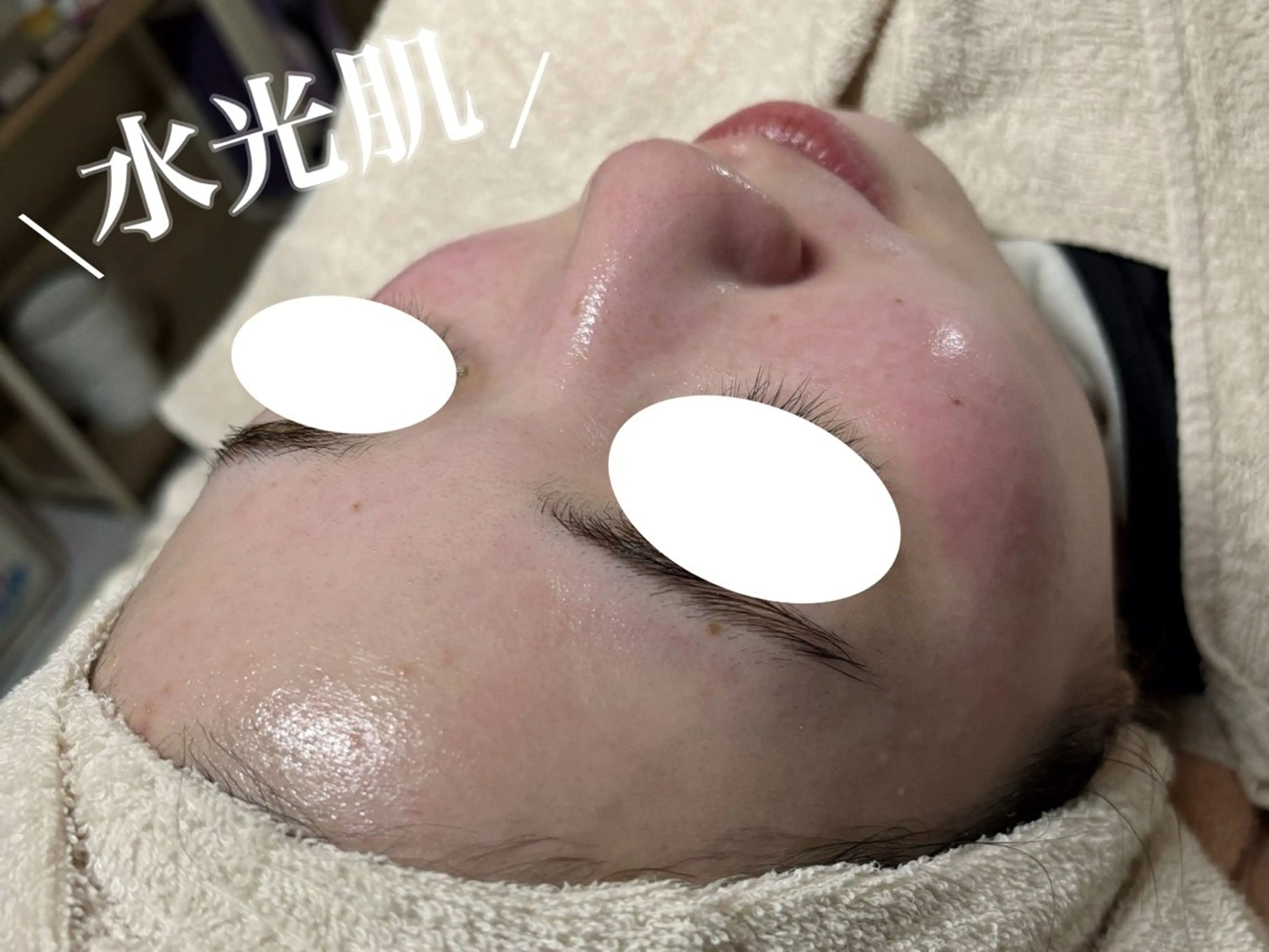 フェイシャルワックス✨美肌目的の無添加WAX✨毛穴詰まり、お顔表面の汚れ、産毛除去⭐︎ヒト幹細胞パック付の写真