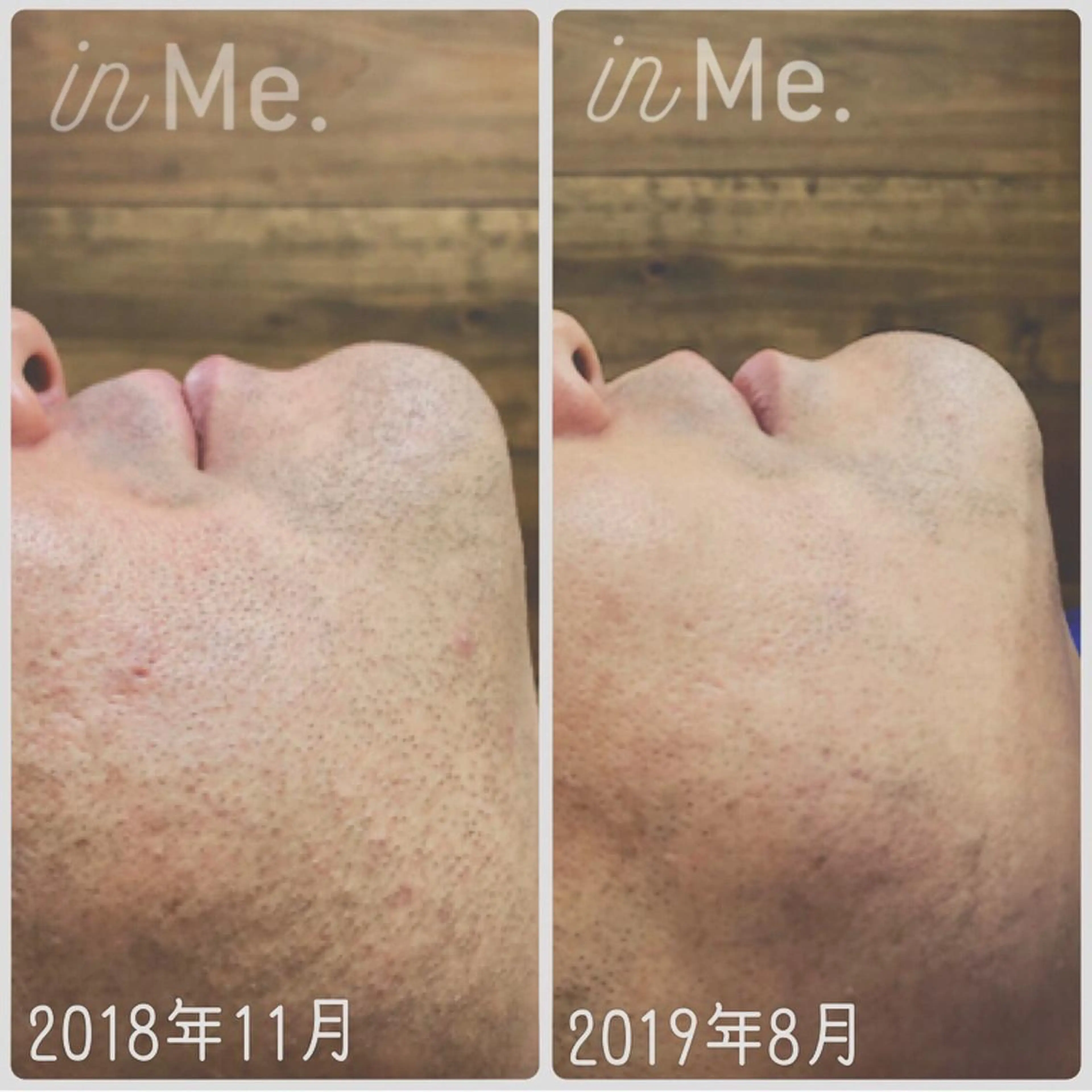 🍀メンズヒゲ脱毛🥸🍀メンズのお顔全体の脱毛です✨しぶといヒゲを無くしていき剃刀負けの肌荒れもみるみる綺麗に💓の写真