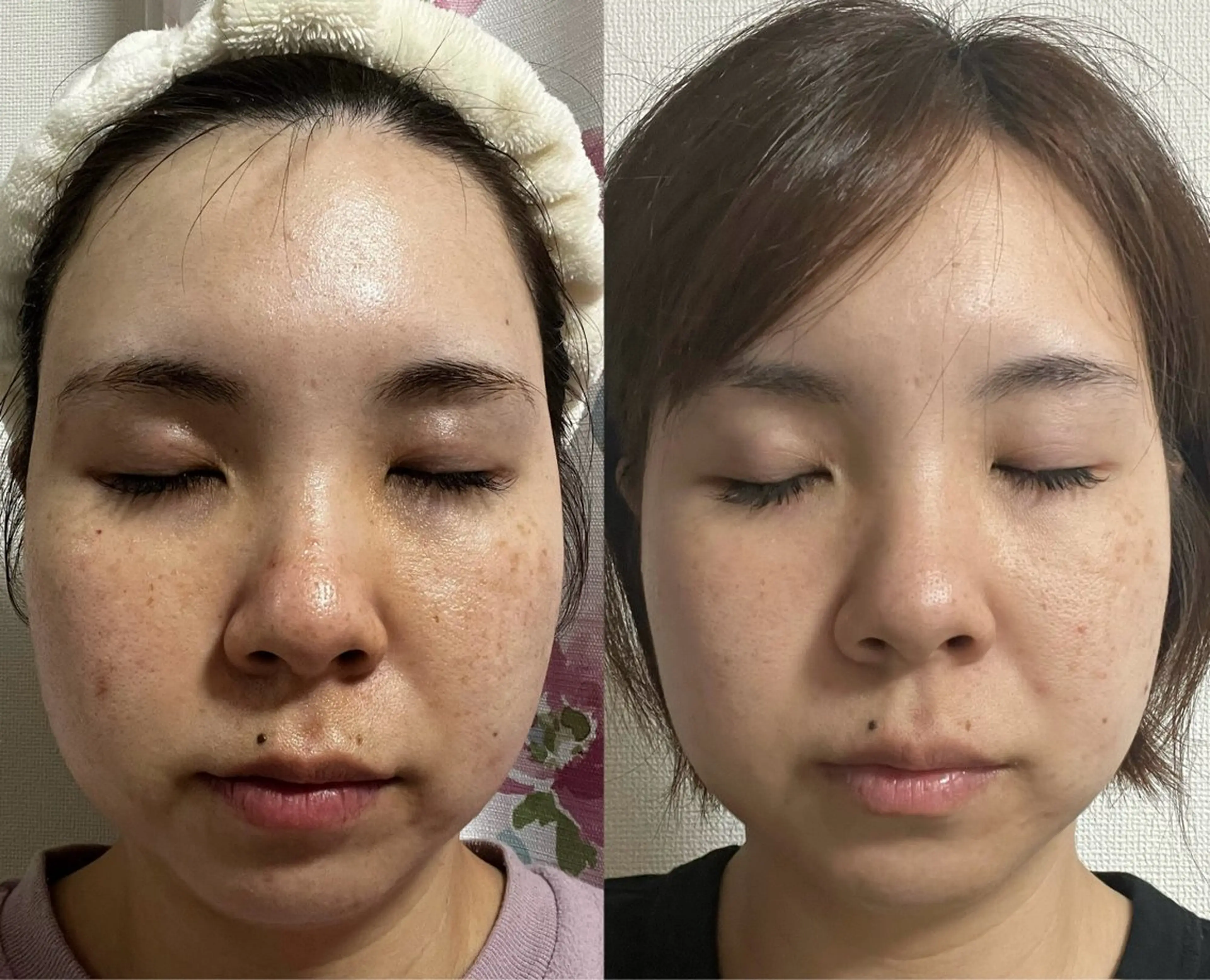 【ミニモ特別価格】美肌施術・リフトアップ施術の写真