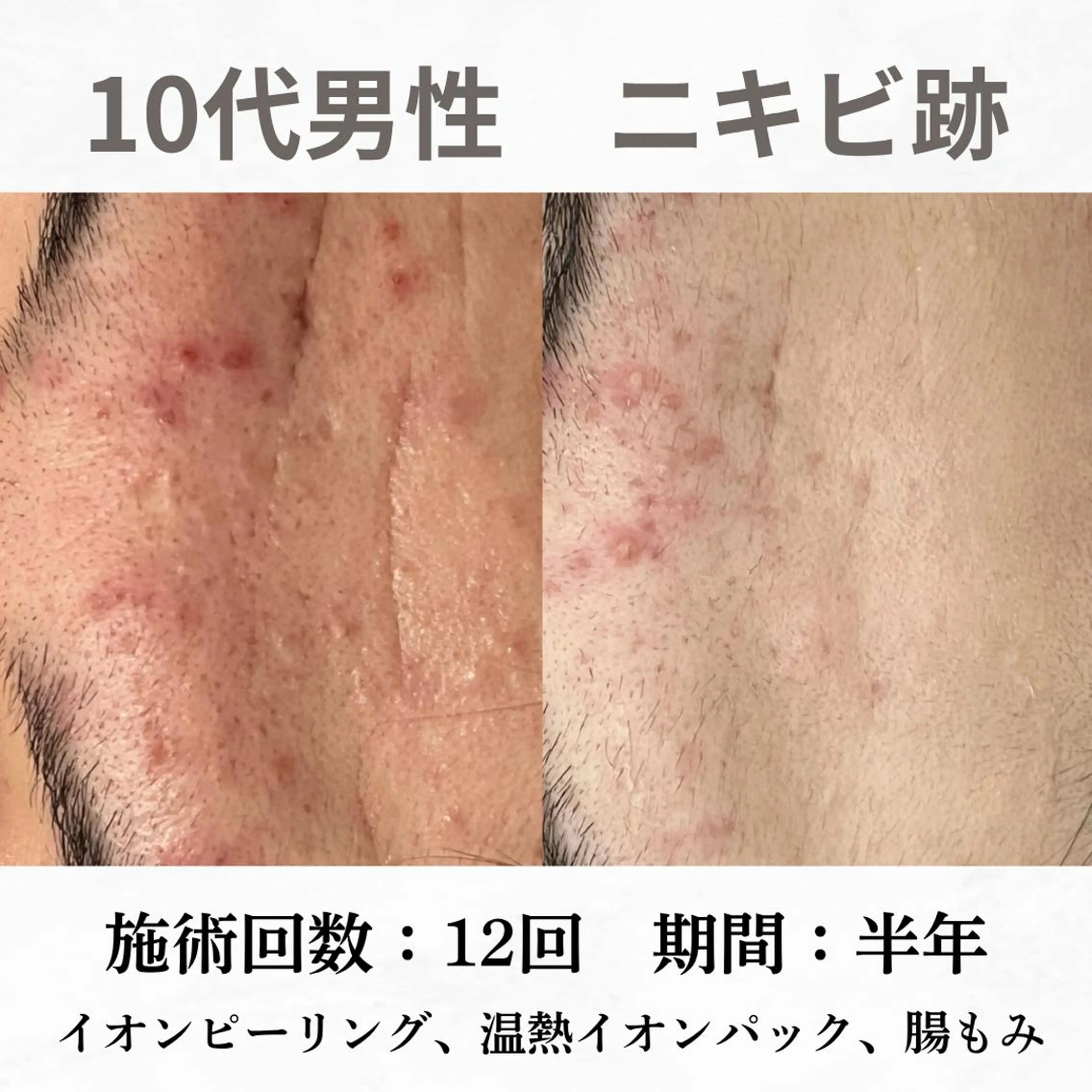 重度ニキビ専門🌷 ダウンタイムなしのエステ・リラクイメージ