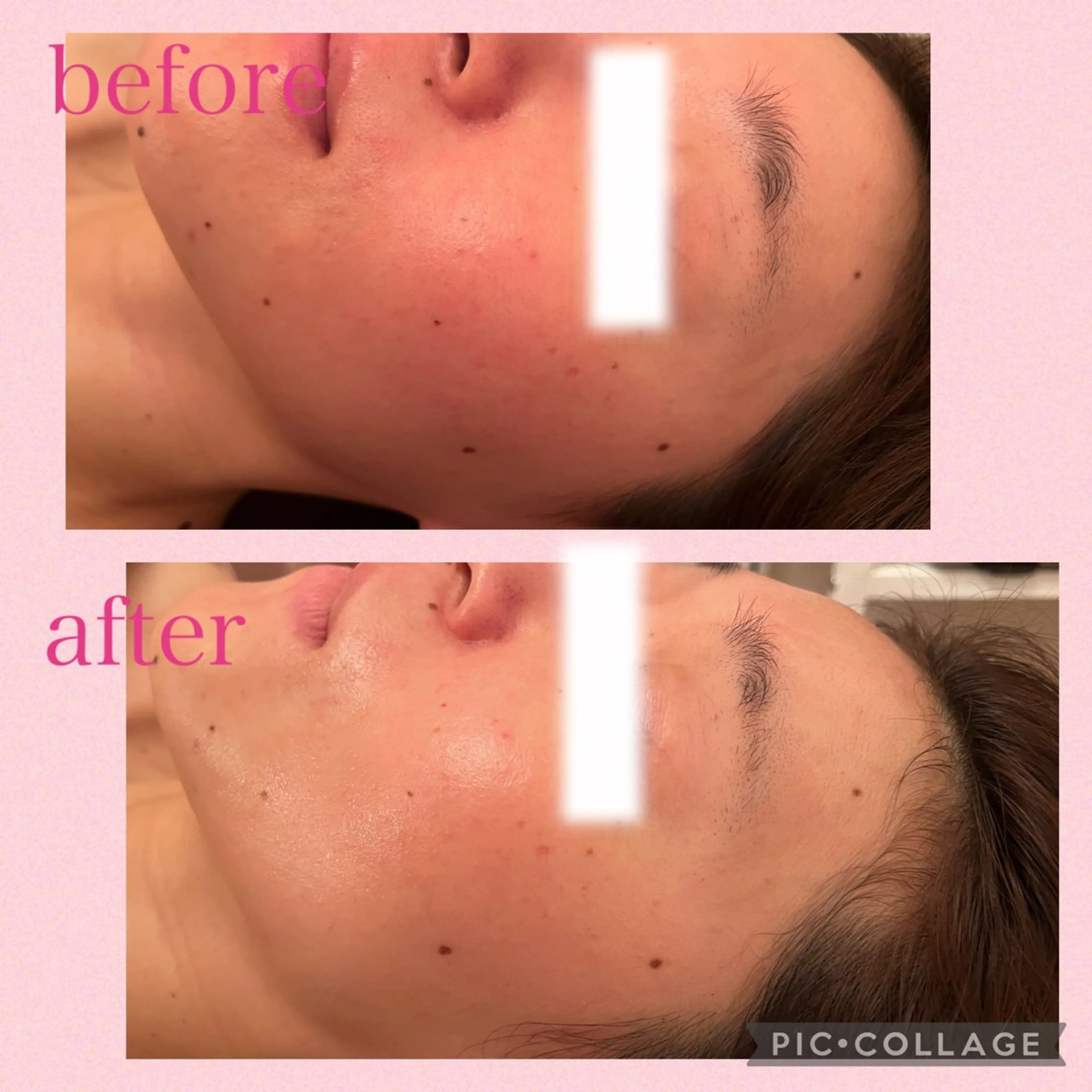 3/25迄ハーブ ピーリングBloomのエステ・リラクイメージ