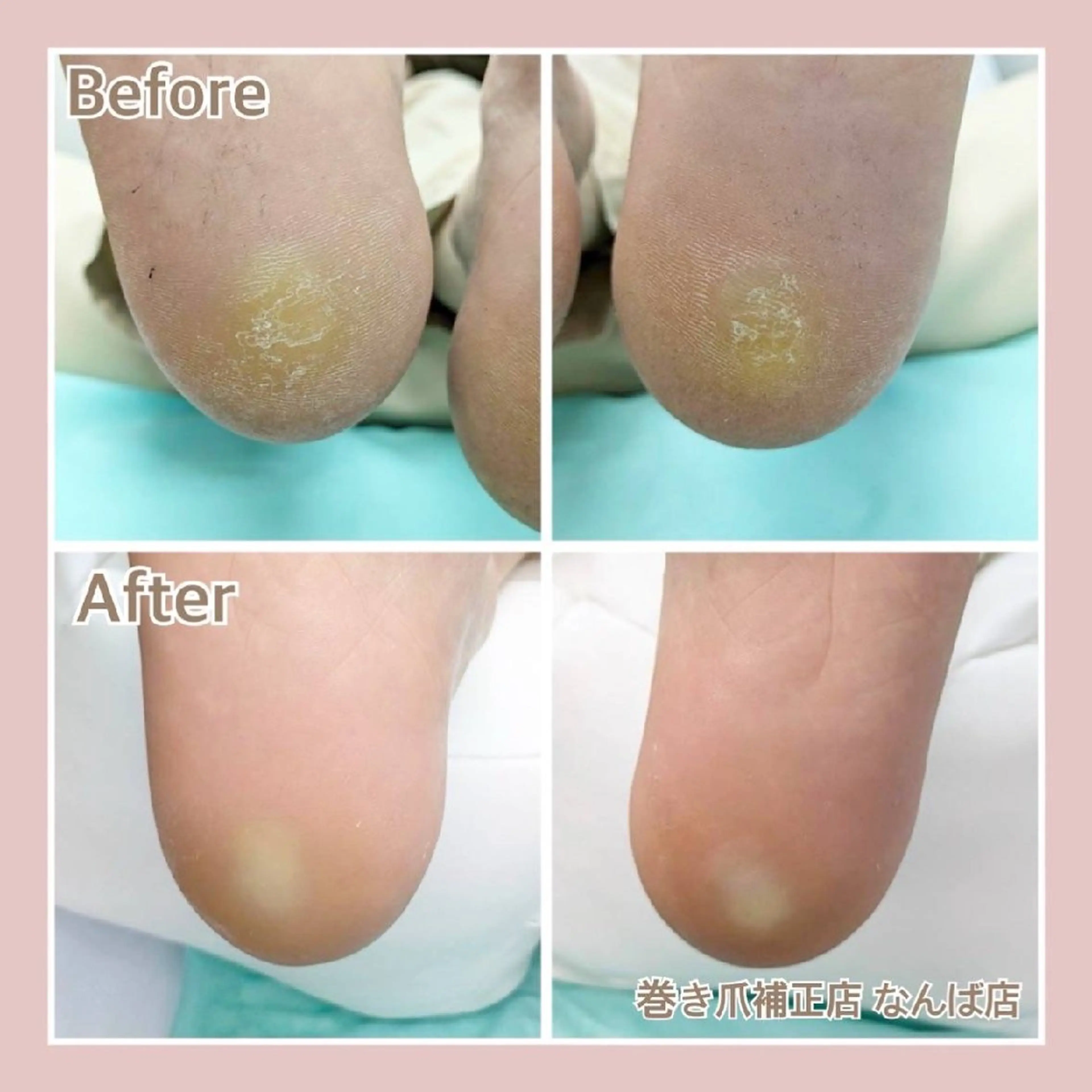 かかと角質ケア　ガサガサして靴下に引っかかる。そんなかかともツルツルに仕上げます。の写真