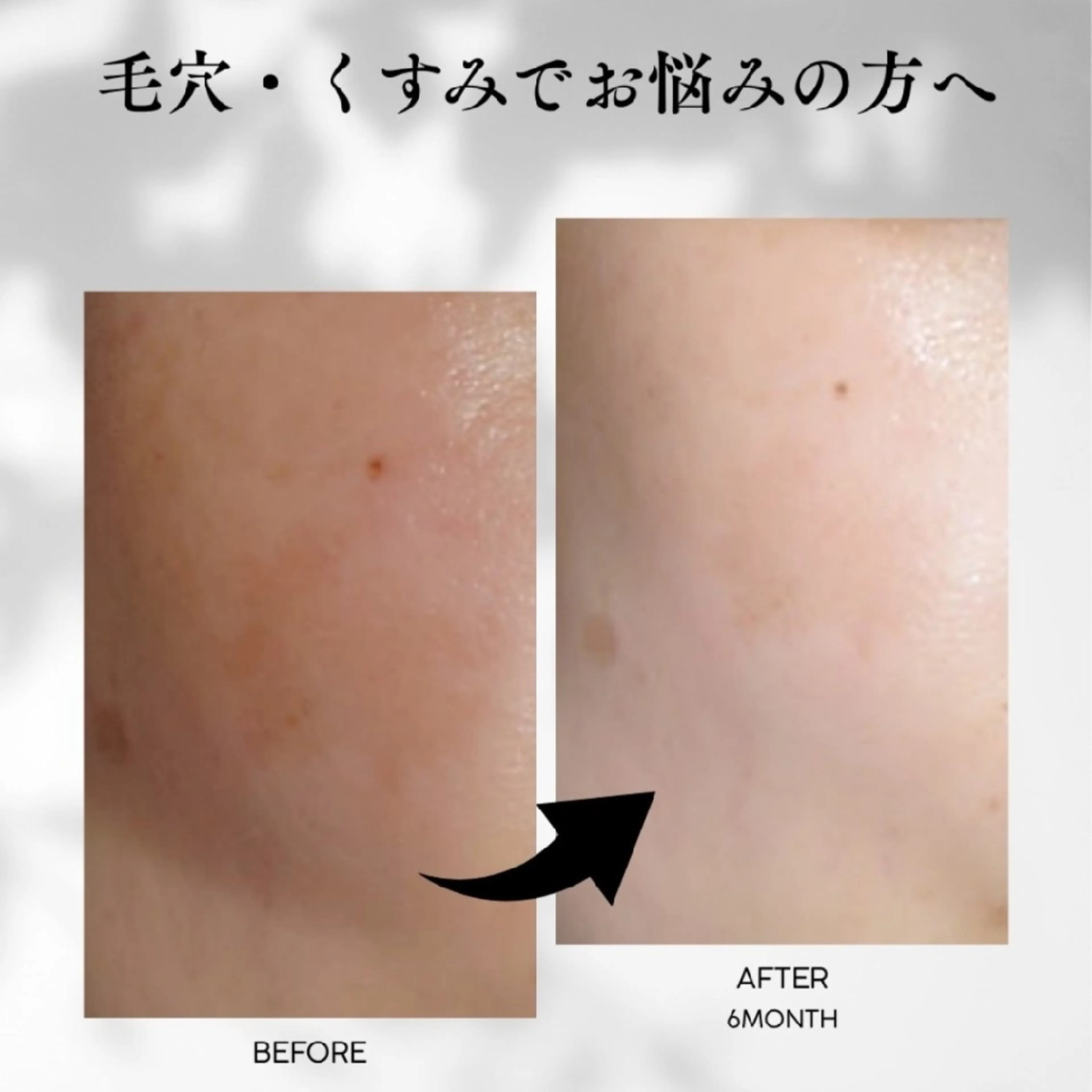 【人気No.1】毛穴・くすみ・肌荒れ改善フェイシャル✨の写真