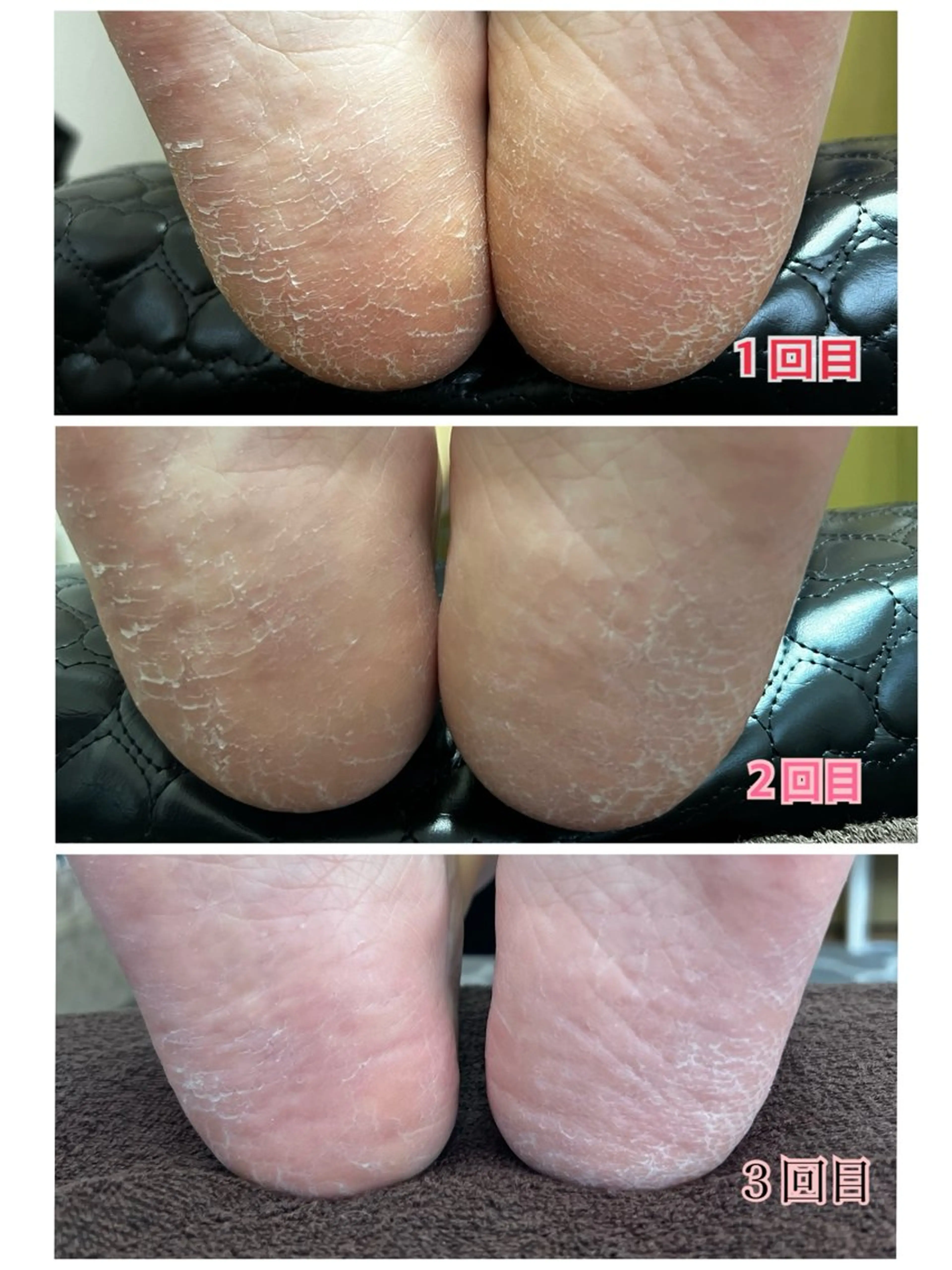 フットケア（爪の形を整え、甘皮ケア、足裏の硬くなった角質ケア）の写真