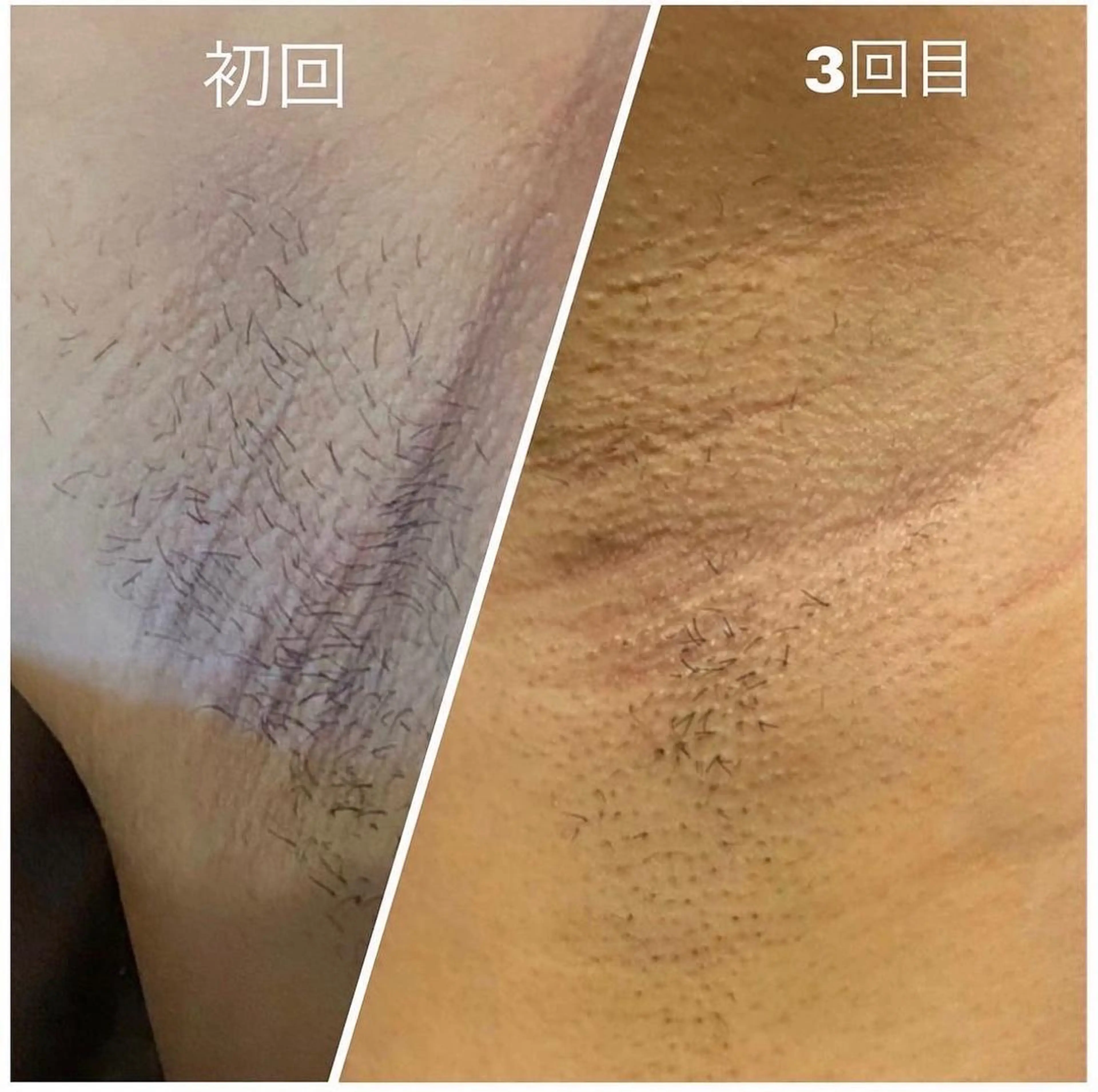 脱毛 脱毛MAX 代表 まなみのエステ・リラクイメージ