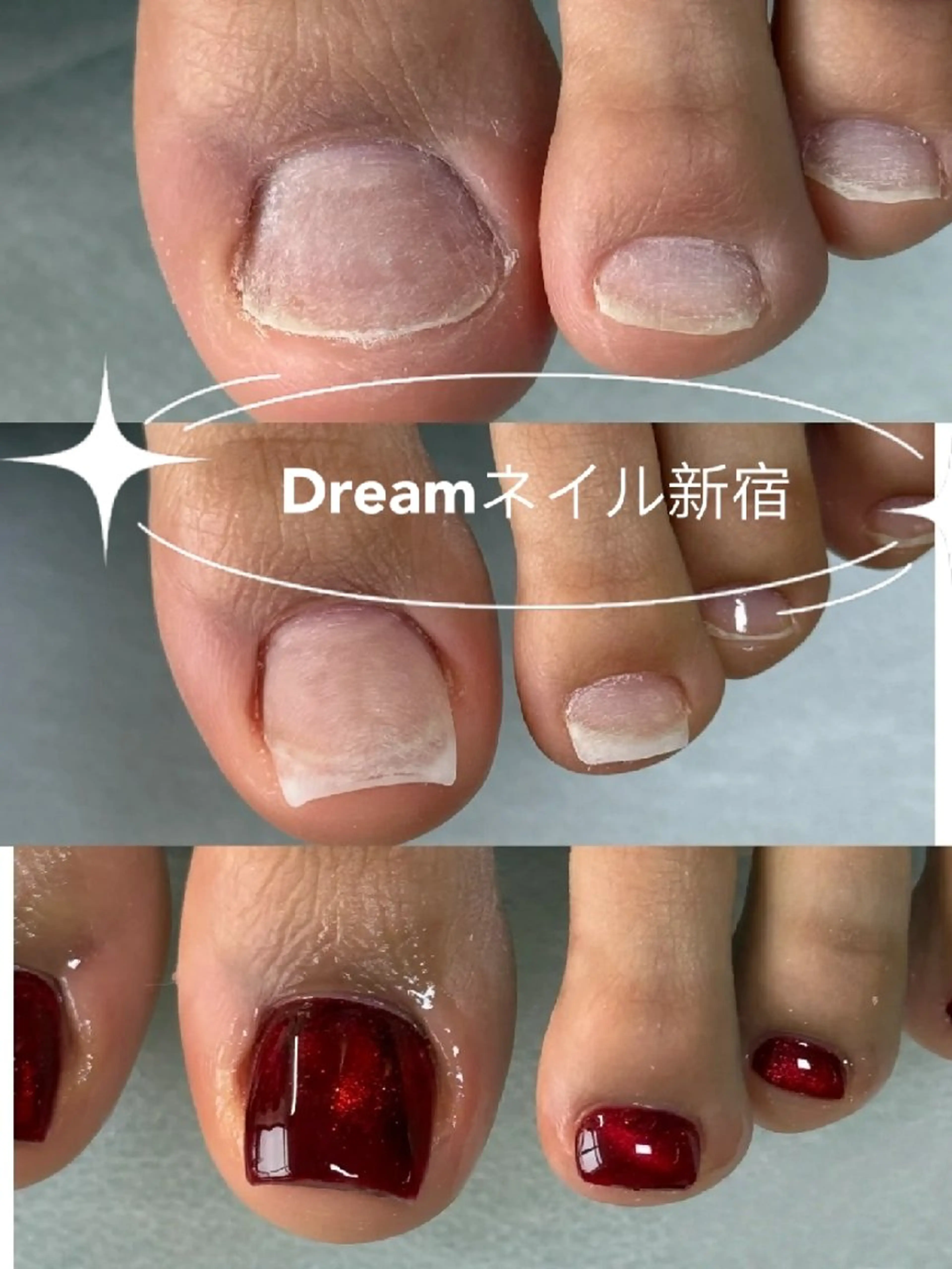 ネイル マグネットネイル フットネイル フィルイン・深爪矯正 長さ出し・リラク

のネイルデザイン