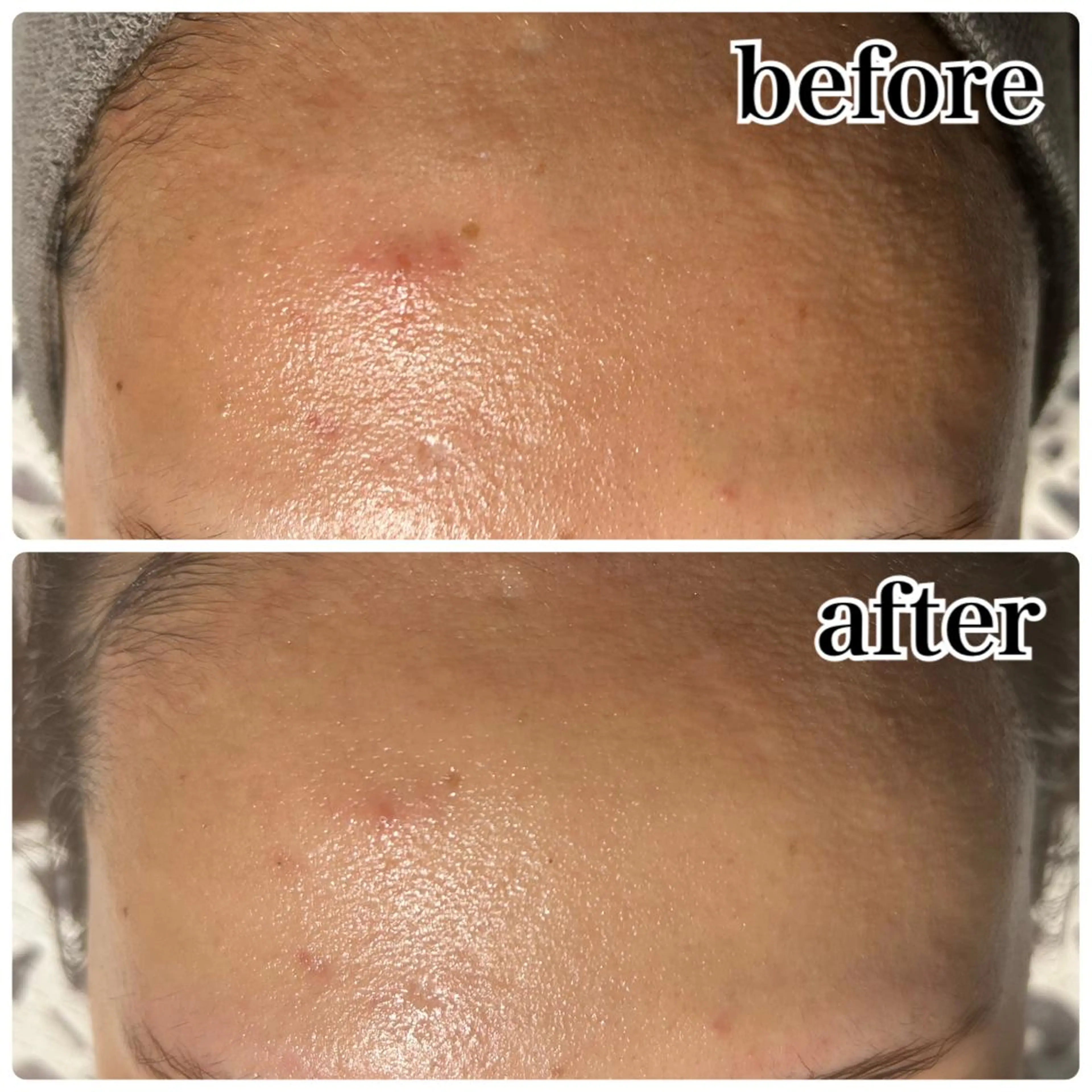 ニキビ、ニキビ跡、毛穴、しみ、くすみに✨REVI陶肌トリートメント(ハーブ2g+エンザイム1g【酵素パウダー】)の写真