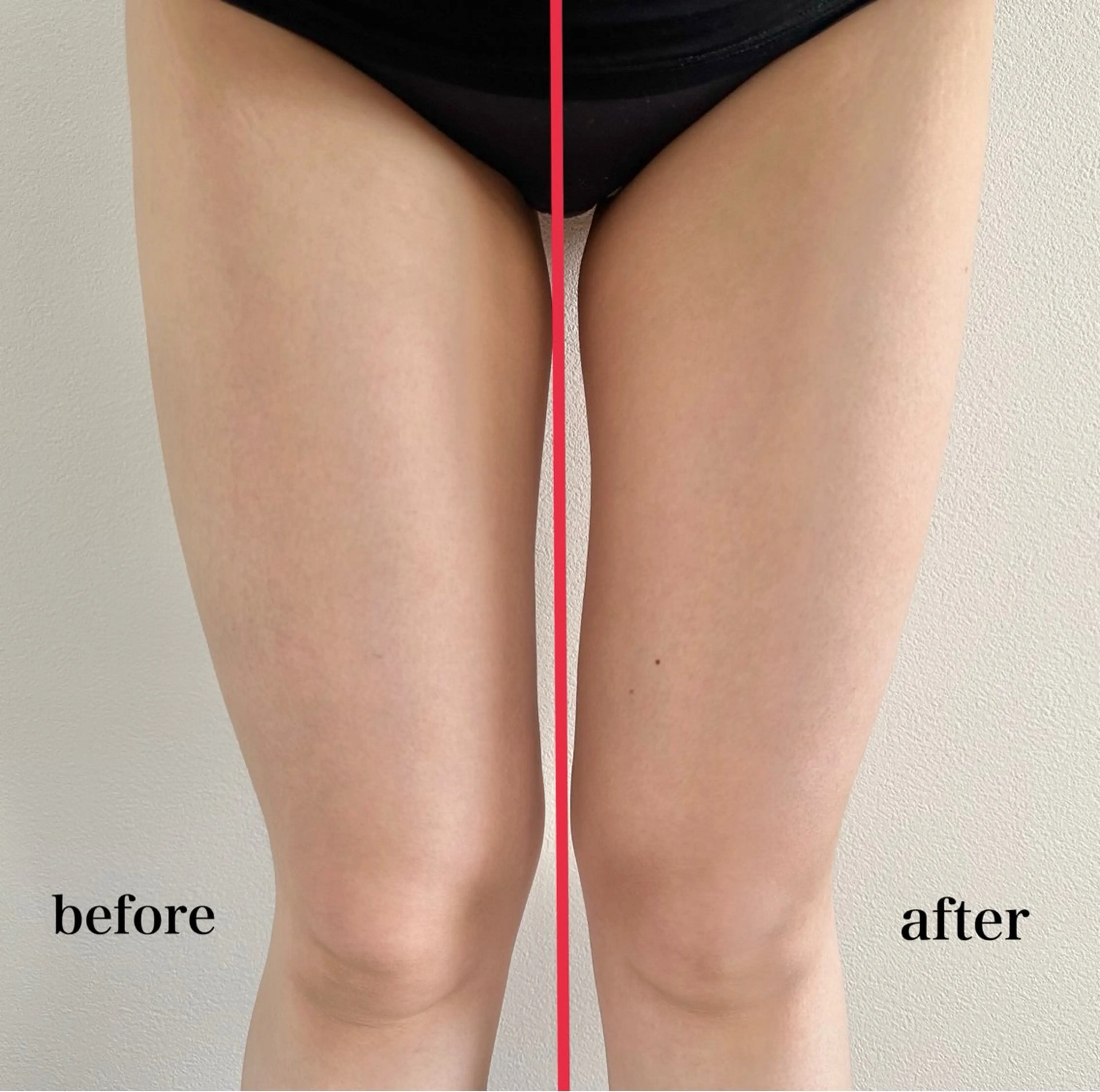 【目に見て分かる痩身効果！】エアインジェクター導入（2箇所）+マッサージ（1部位）の写真