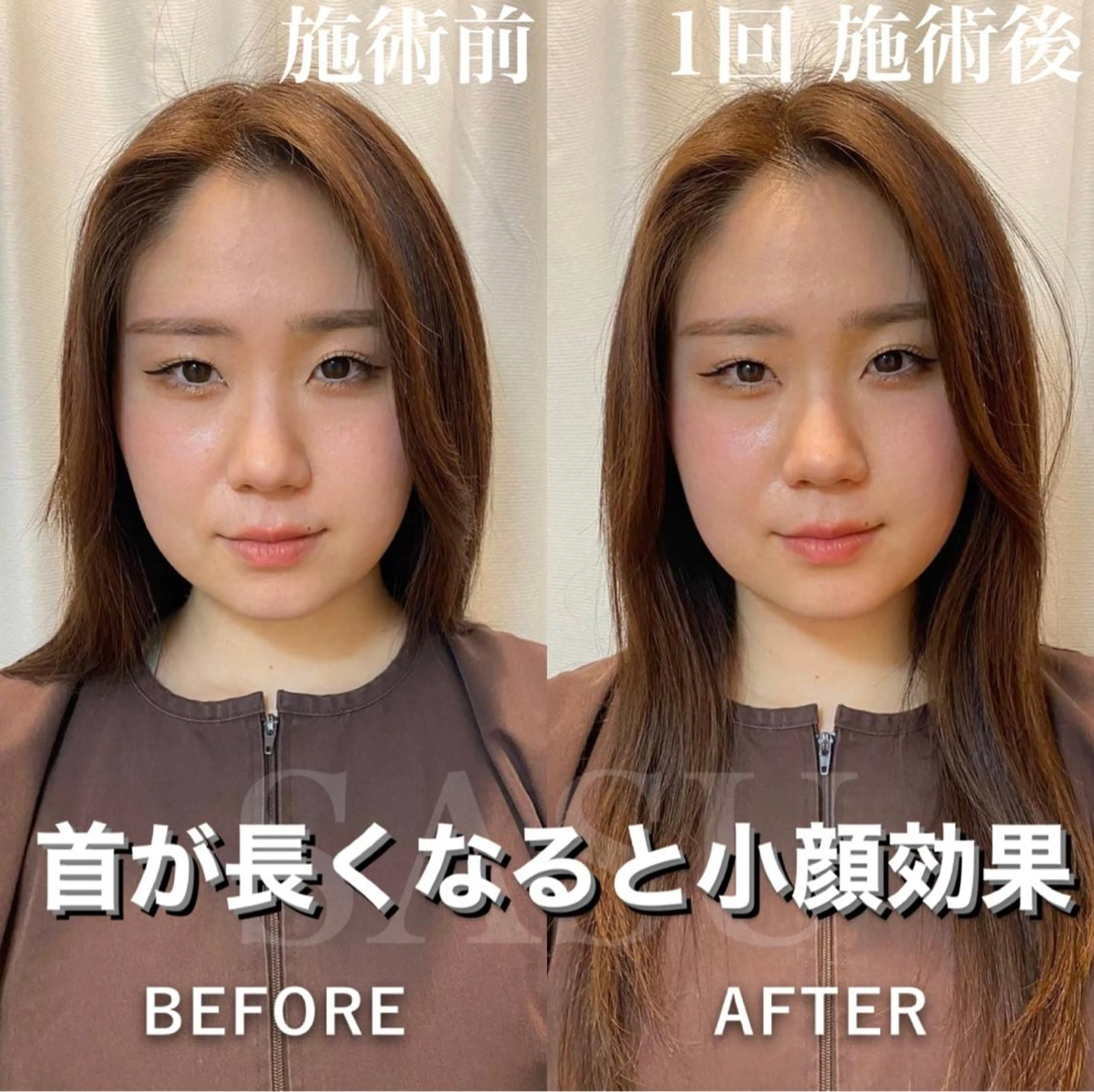 ロング カラー パーマ ヘアアレンジ メンズ キッズ ネイル マツエク・マツパ アイブロウ その他 即小顔♥️美容鍼× ハーブピーリングのその他イメージ