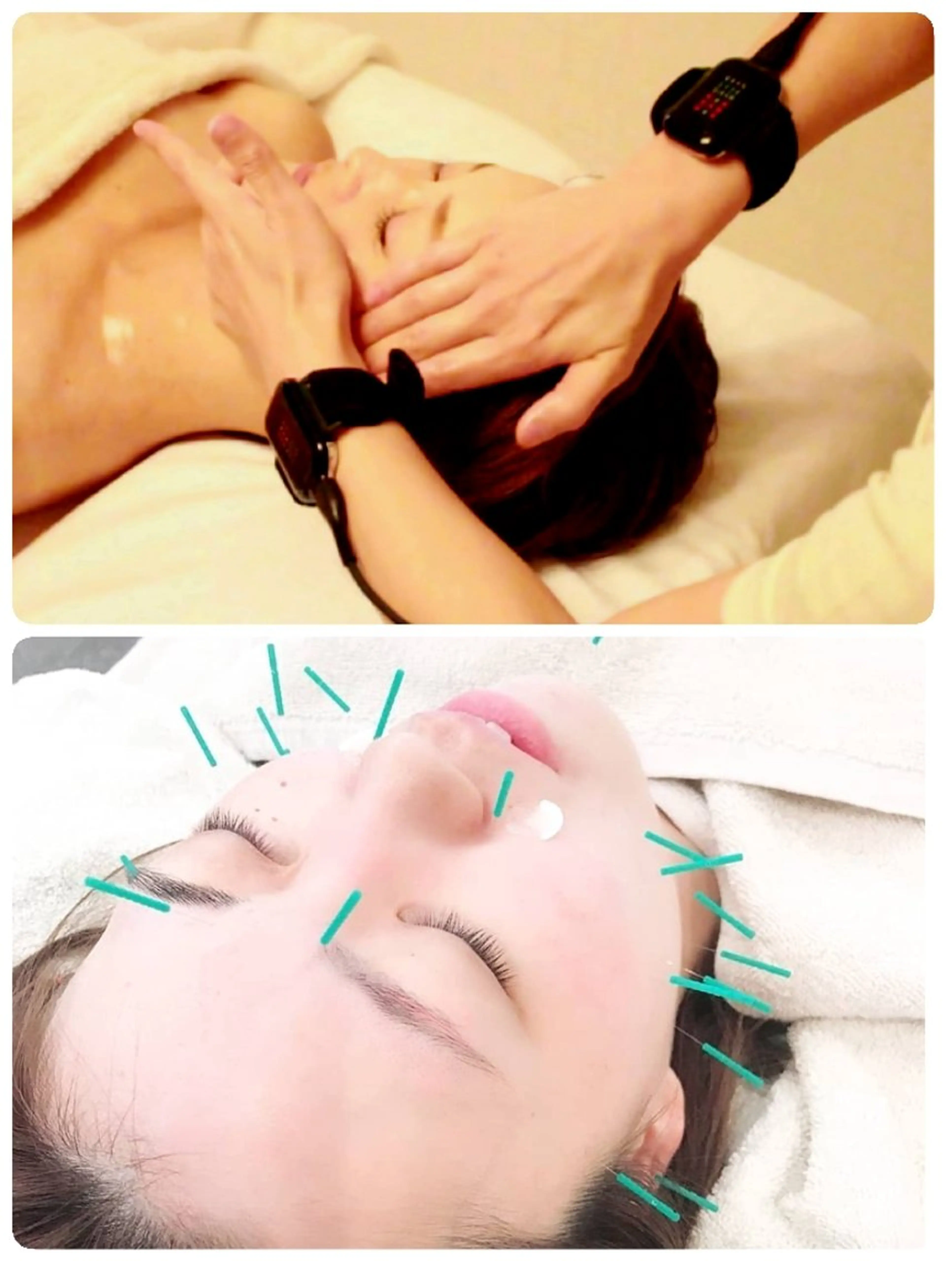 👑人気No.1👑ラジオ波➕美容鍼の写真