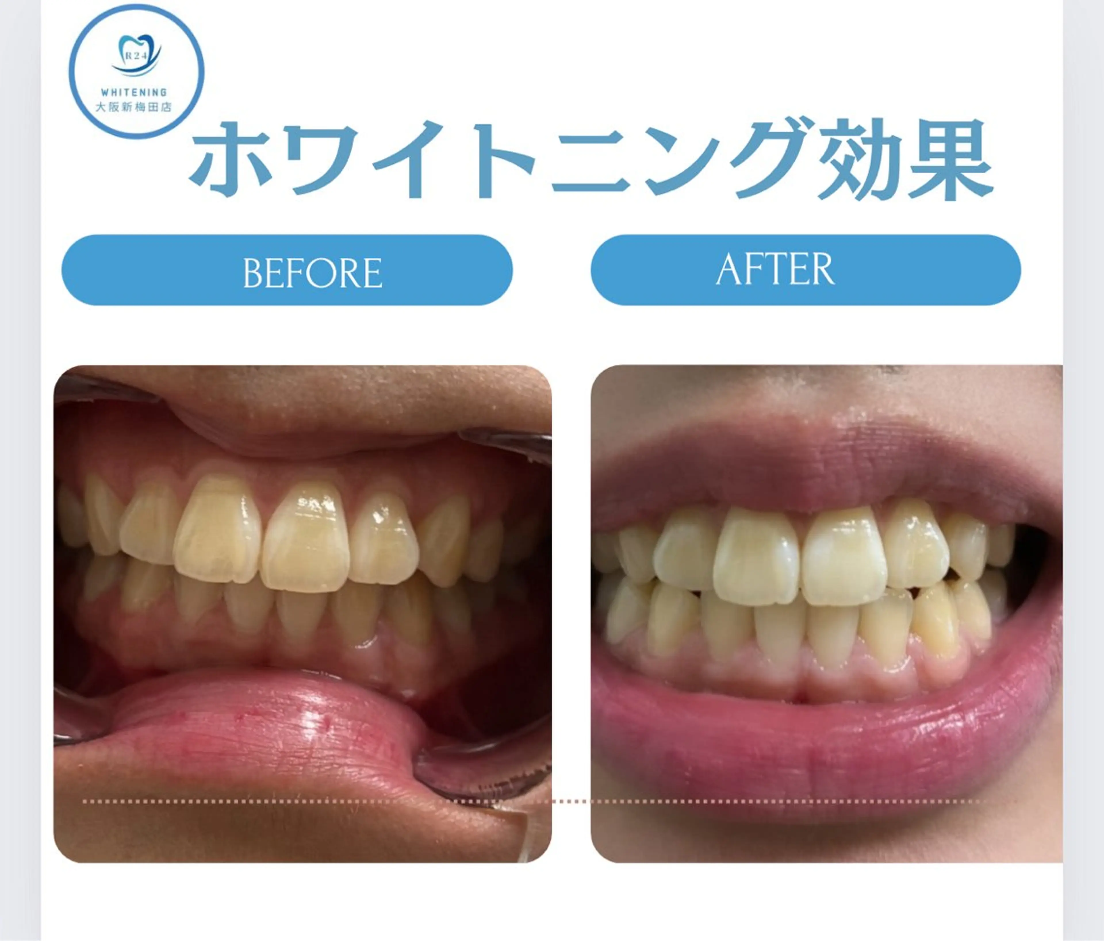 本日4月13日(月)¥1580セルフホワイトニング🦷:(梅田最安値)先着3名20分照射当日直前予約🉑の写真