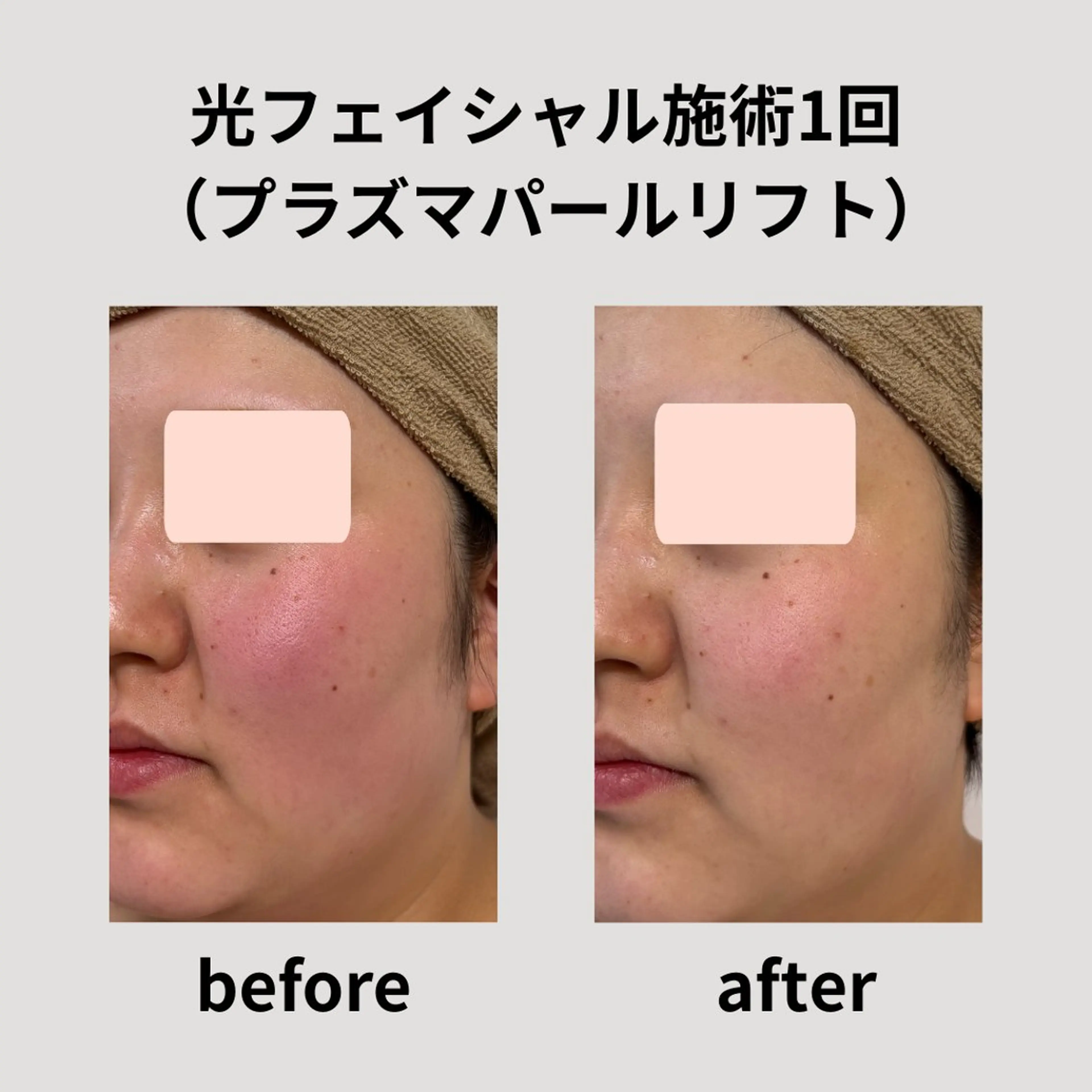 脱毛 脱毛＆フェイシャル H'euriaのエステ・リラクイメージ