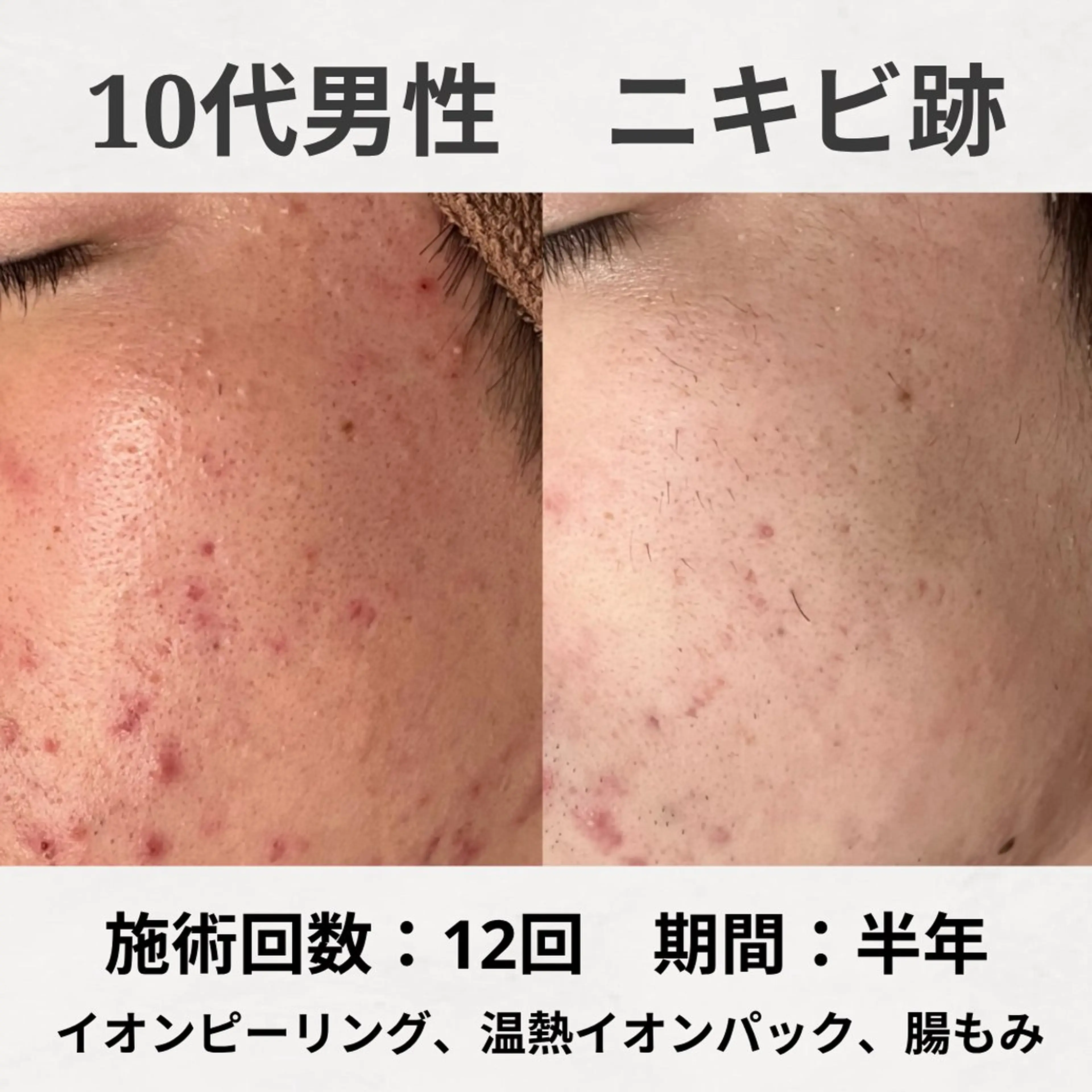 エステ リラク ニキビ跡改善専門🔥 医療にはできない改善のエステ・リラクイメージ