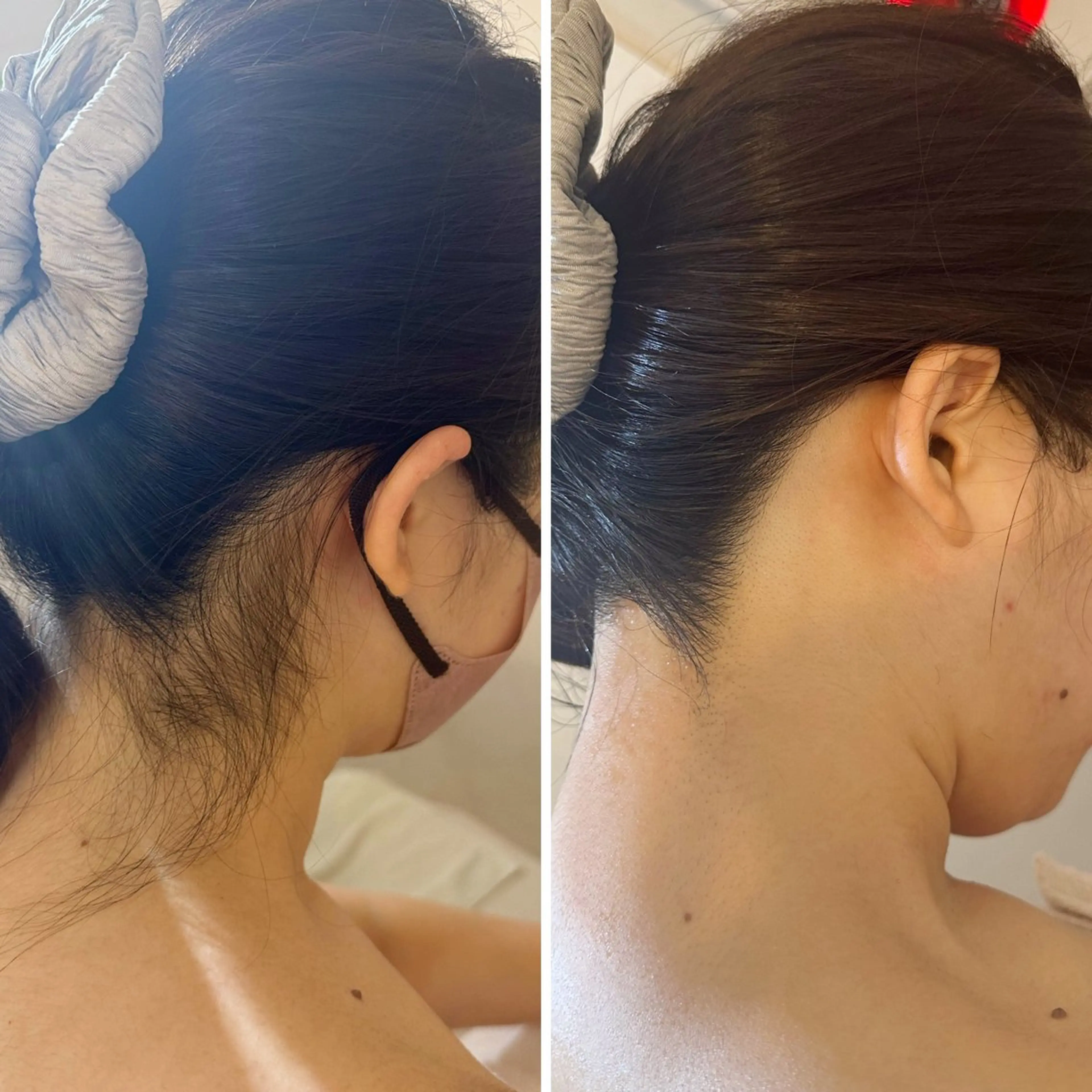 脱毛 うなじ脱毛/美肌脱毛 LABELのエステ・リラクイメージ