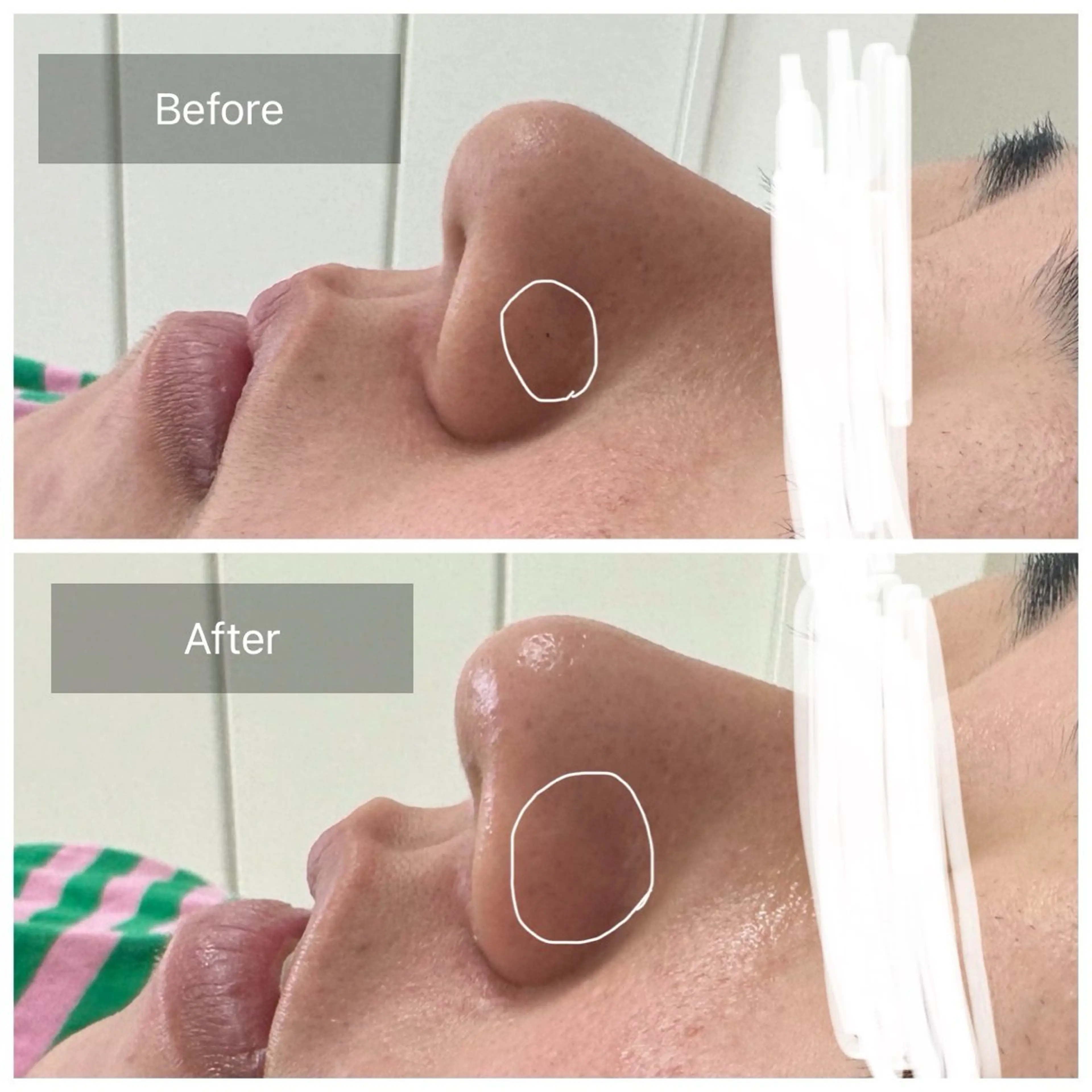 《鼻》お試し価格🥰小鼻の毛穴・ざらつき・黒ずみ!ワックスで改善!毛穴レスを目指して🫧1度で効果を感じられます♡の写真