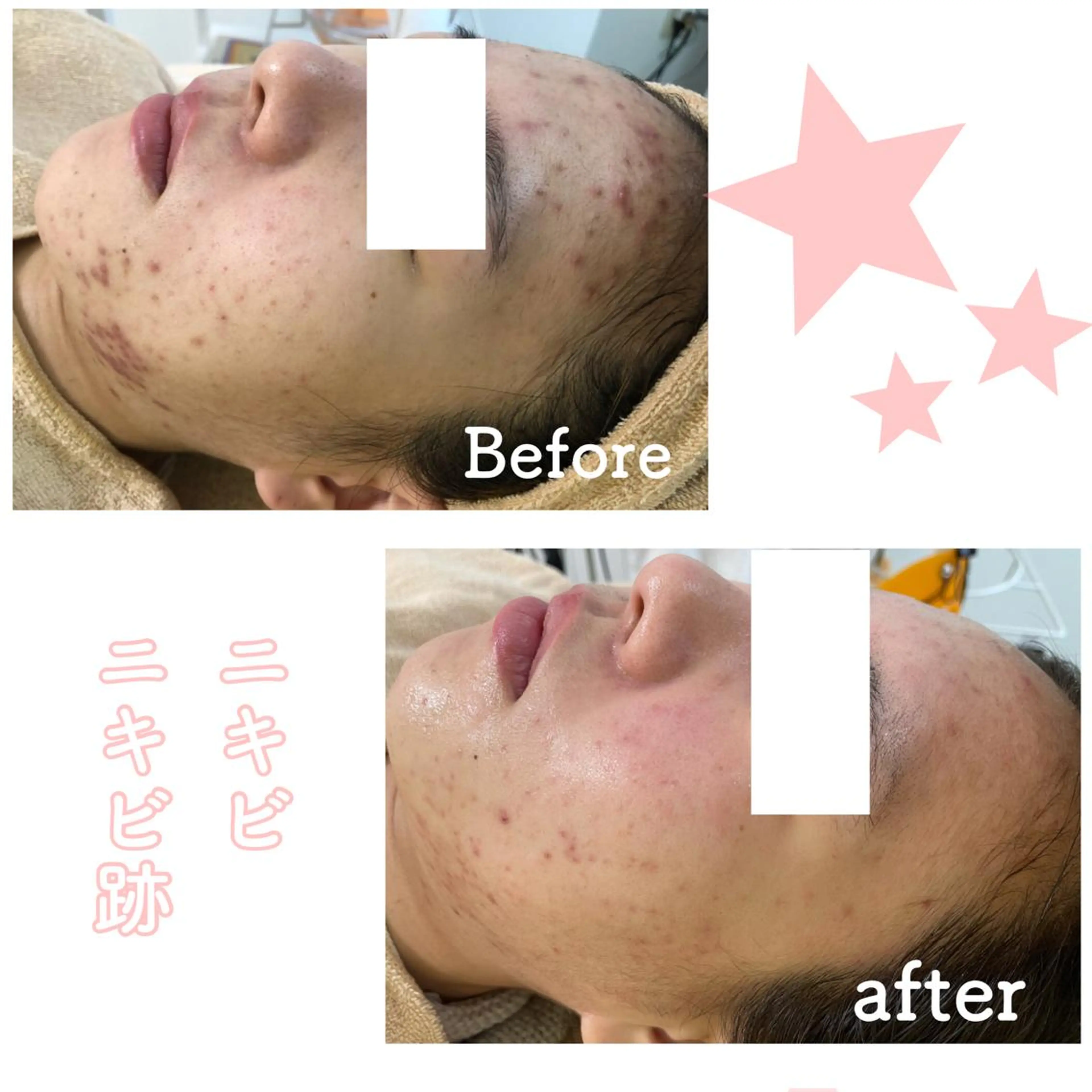 ショート カラー パーマ ヘアアレンジ メンズ キッズ ネイル マツエク・マツパ エステ ニキビ&跡改善サロン オーナー光木のエステ・リラクイメージ