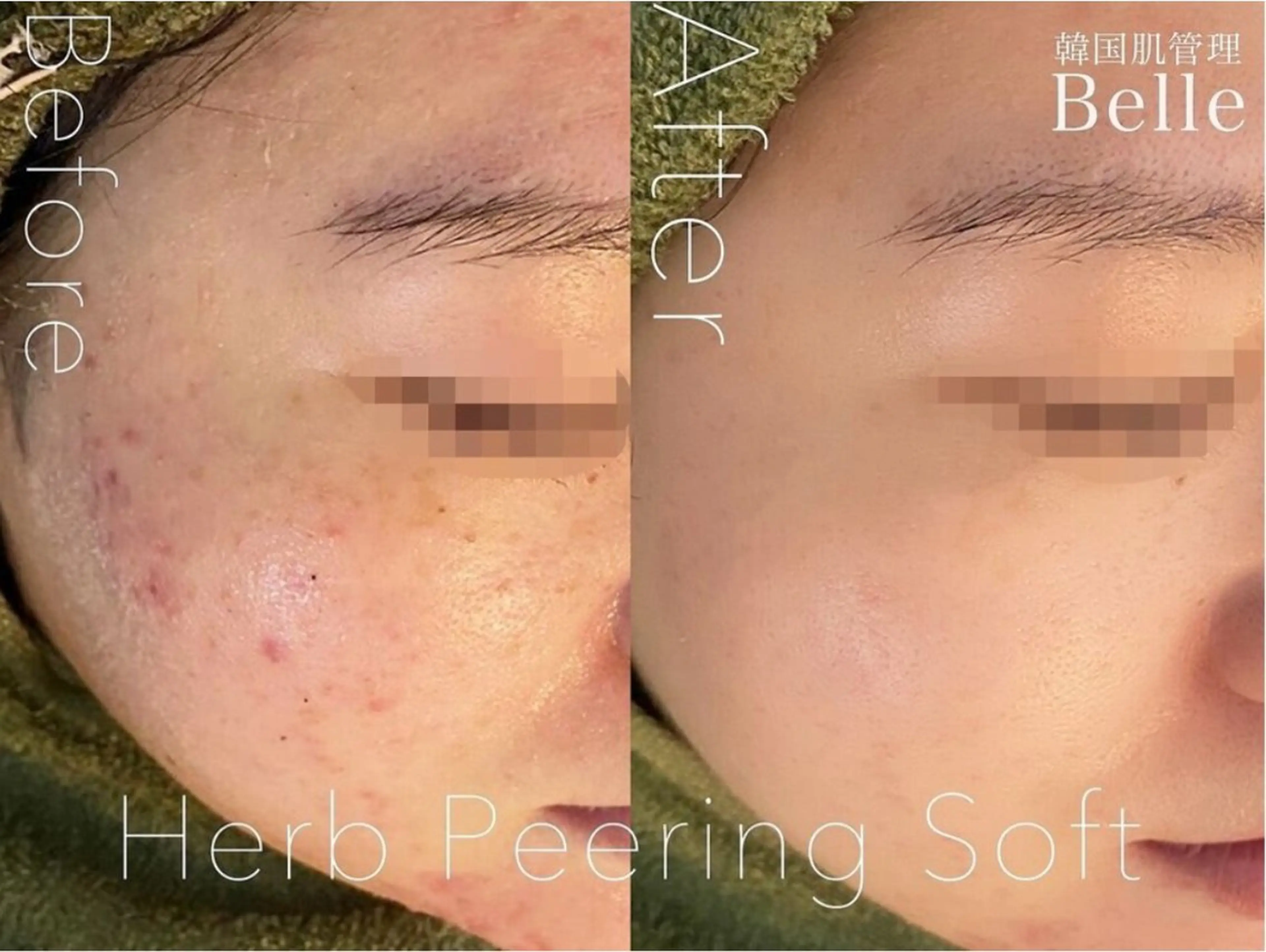 韓国ハーブピーリングBelle目黒限定☆※ご新規の方クチコミ必須メニューの写真