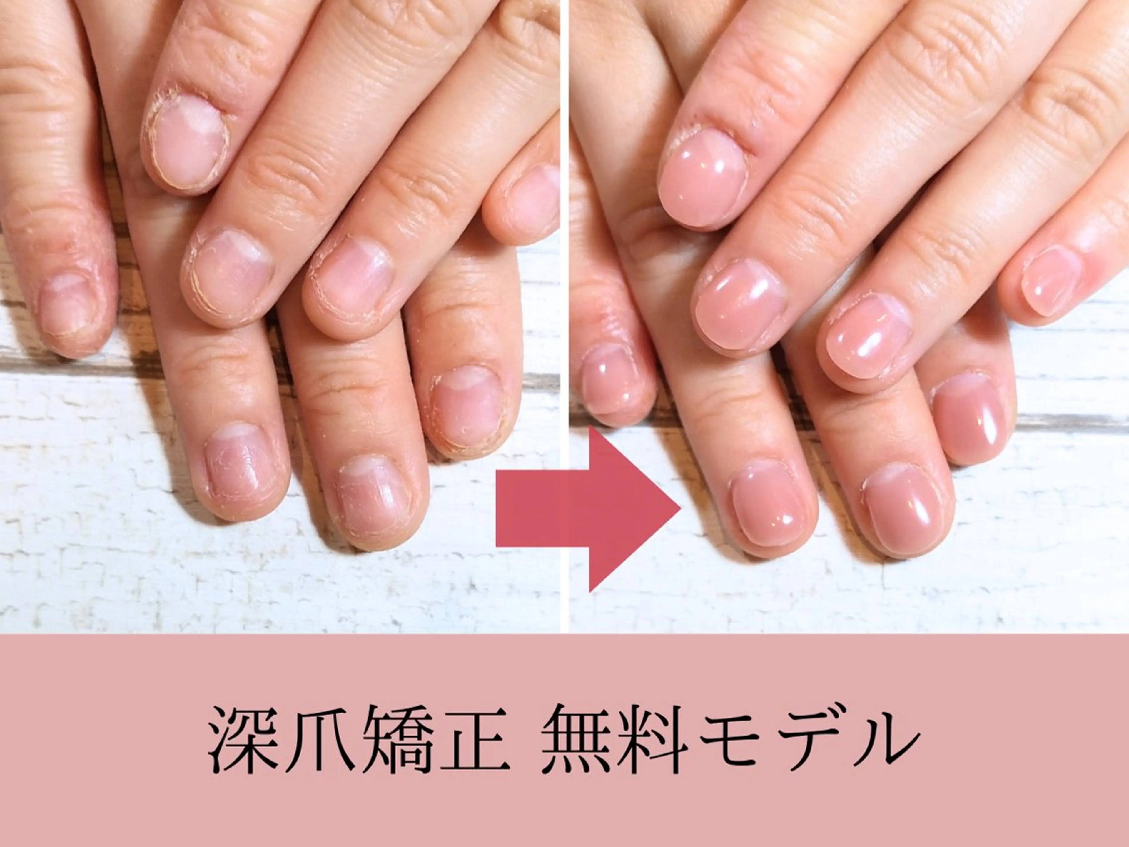 ネイル 深爪矯正・自爪育成 ネイルサロンアモここのネイルデザイン