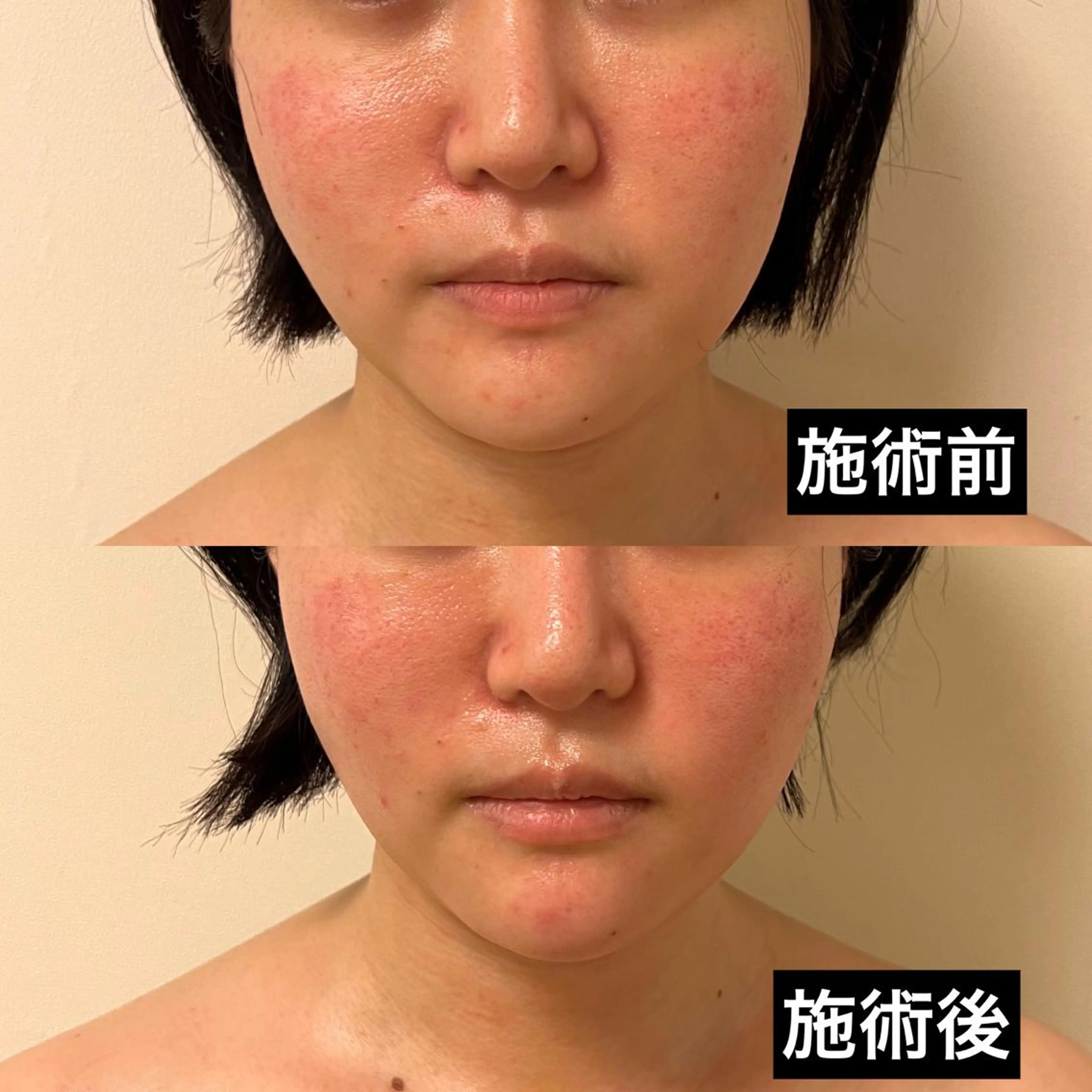 WOM SALON所属・MIKU【美容整形ダ ウンタイムケア銀座】のエステ・リラクイメージ