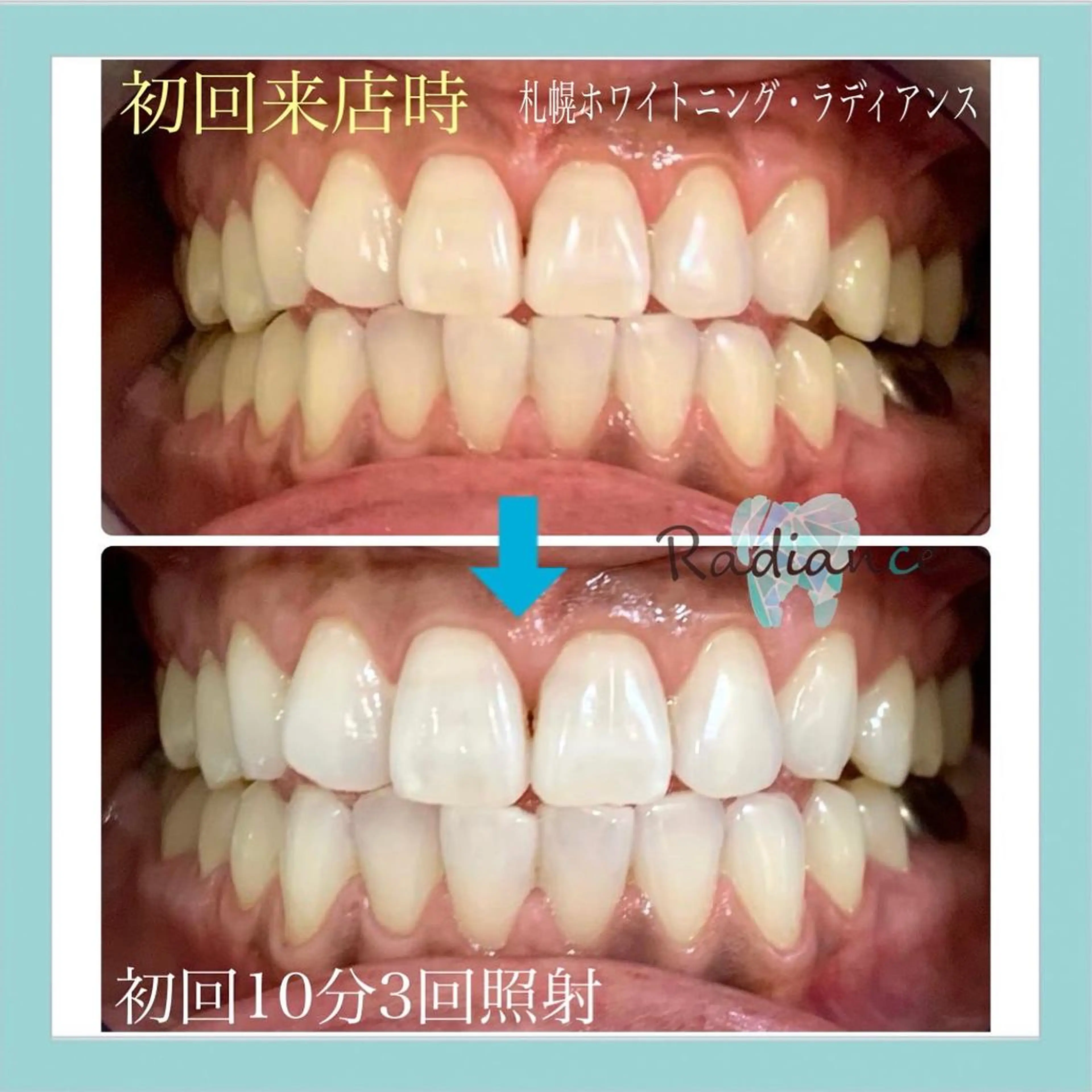 【都度払い】感動ホワイトニングをもう1度🦷✨プラチナムハイパワーライト10分3回照射の写真